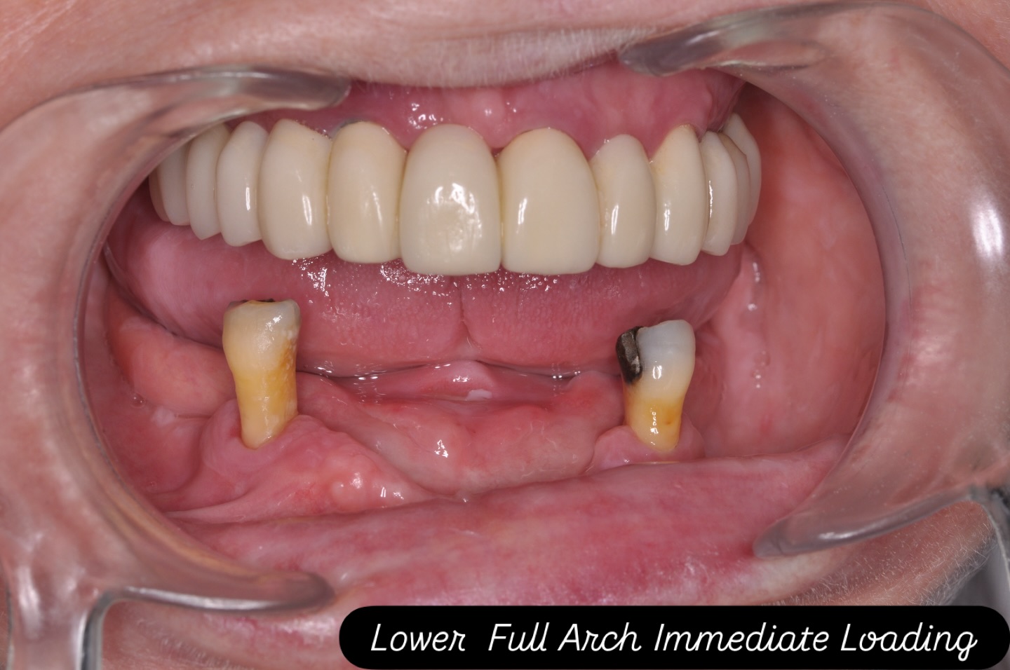 Lower full arch immediate loading today (IFAL). #fullarchdentalimplants #fullarchimmediateload #dentalimplantsprestwich #dentalimplantsmanchester #teethinaday
