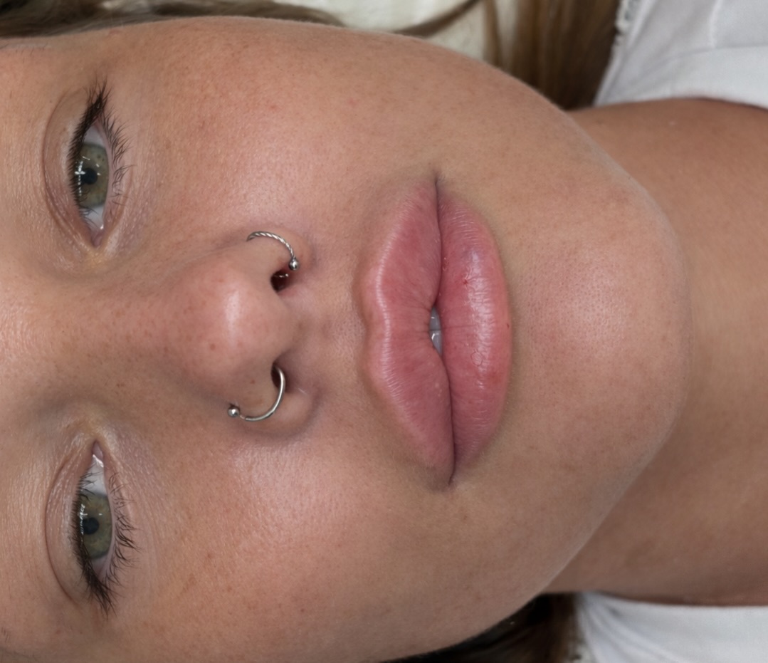 Lip filler top-up ✨
Precise. Controlled. Intentional.