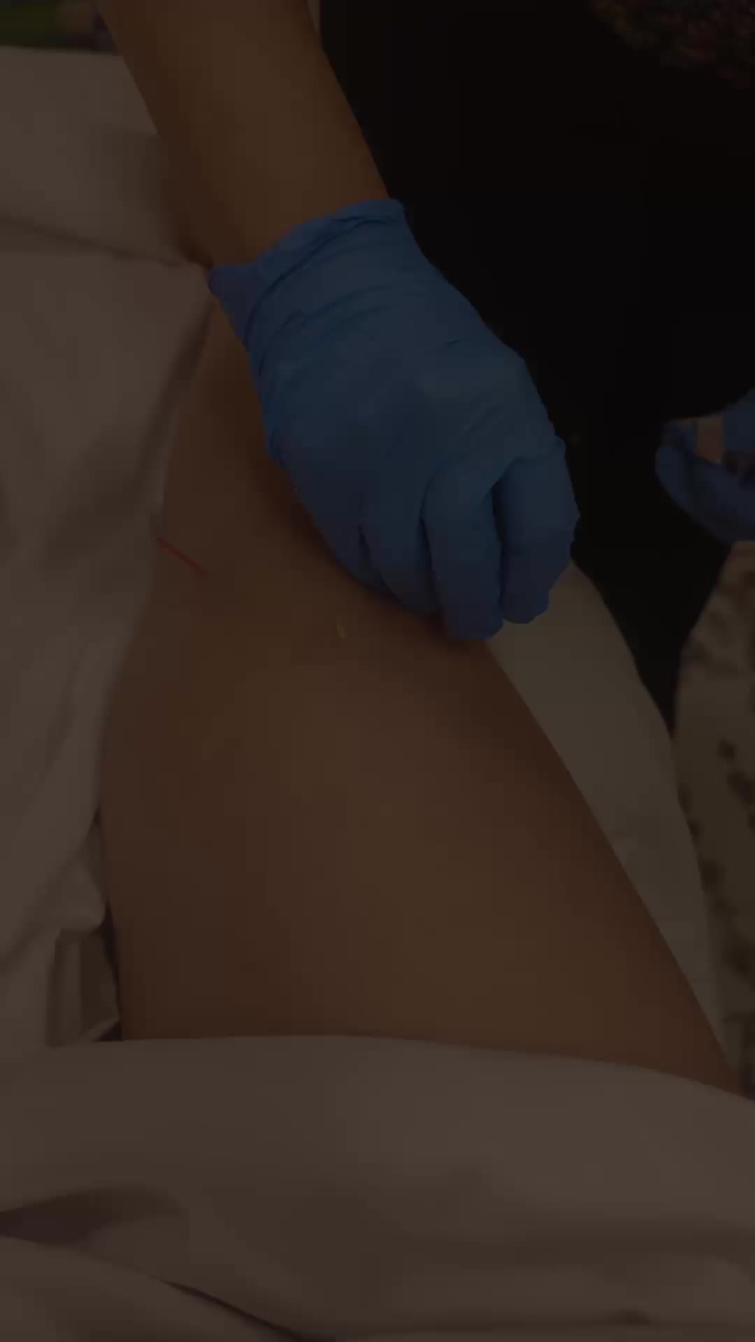 Dry needling is a therapeutic technique used by trained providers to support muscle relaxation and pain relief.Using very thin, sterile needles, targeted areas of muscle tension are gently stimulated to encourage improved movement, circulation, and the body’s natural healing response.Everyone’s body responds differently. Some people experience mild soreness or tenderness afterward, which is typically temporary.Dry needling may be a helpful option for muscle tightness, headaches, or ongoing discomfort when used as part of a personalized care plan that can include movement and corrective exercises. #dryneedling #healthylifestyle #Wellness #HolisticHealing