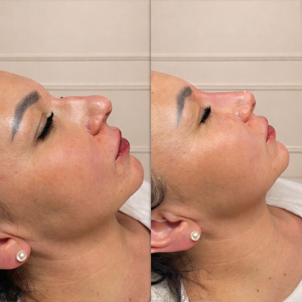 Before & afters like this aren’t beginner work.
This kind of result comes from precision, restraint, and confidence — understanding nasal anatomy, respecting vascular risk, and knowing exactly how to create balance without overfilling.
That’s why I normally reserve nose filler training exclusively for my Expert Fillers students.
For a short window only, I’m opening nose filler training inside my Advanced Fillers Course — giving you access to a skill most practitioners don’t confidently offer.
🎓 Course: £499
💉 Model treatment: £110 (limited offer)
If you’ve been waiting to truly level up your skill set — this is it.
DM ADVANCED to secure your place 🤍