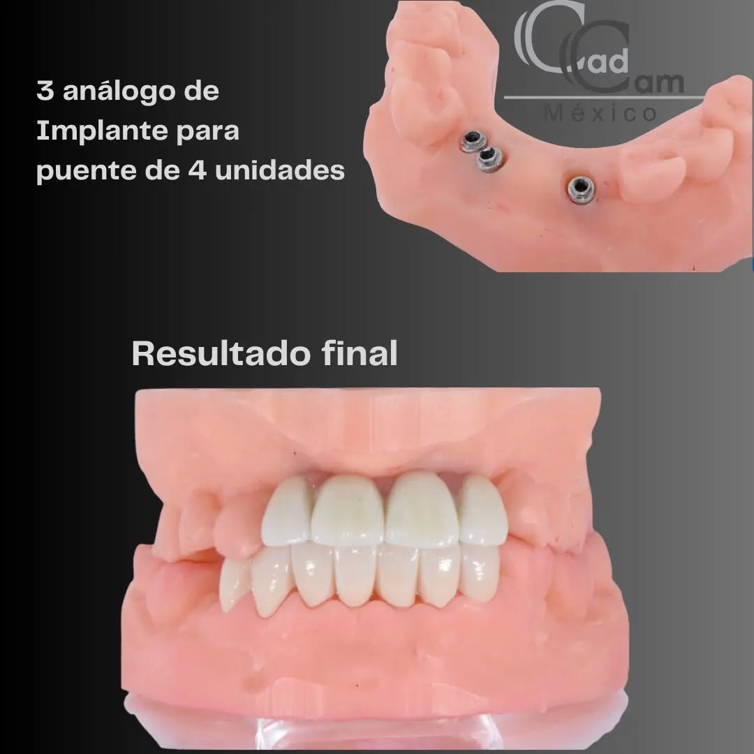 1
Una rehabilitación compleja en frontales requiere alta estética, trabajando con @implantshopmexico podemos coordinar los análogos y Scan Bodies necesarios. Demostrando la importancia de comunicación y coordinación para su caso de éxito. En @cadcammexico , la excelencia se encuentra en cada detalle. - - - Aviso de responsabilidad: Todas las fotos publicadas en esta cuenta de Instagram son propiedad intelectual de Estudio de Porcelana Suizo S.A de C.V. y están protegidas por derechos de autor.pin alvaro obregon 134 cuernavaca #CadCam #Mexico #Cromocobalto #implantologia #implantesdentales #dentistry #dentista