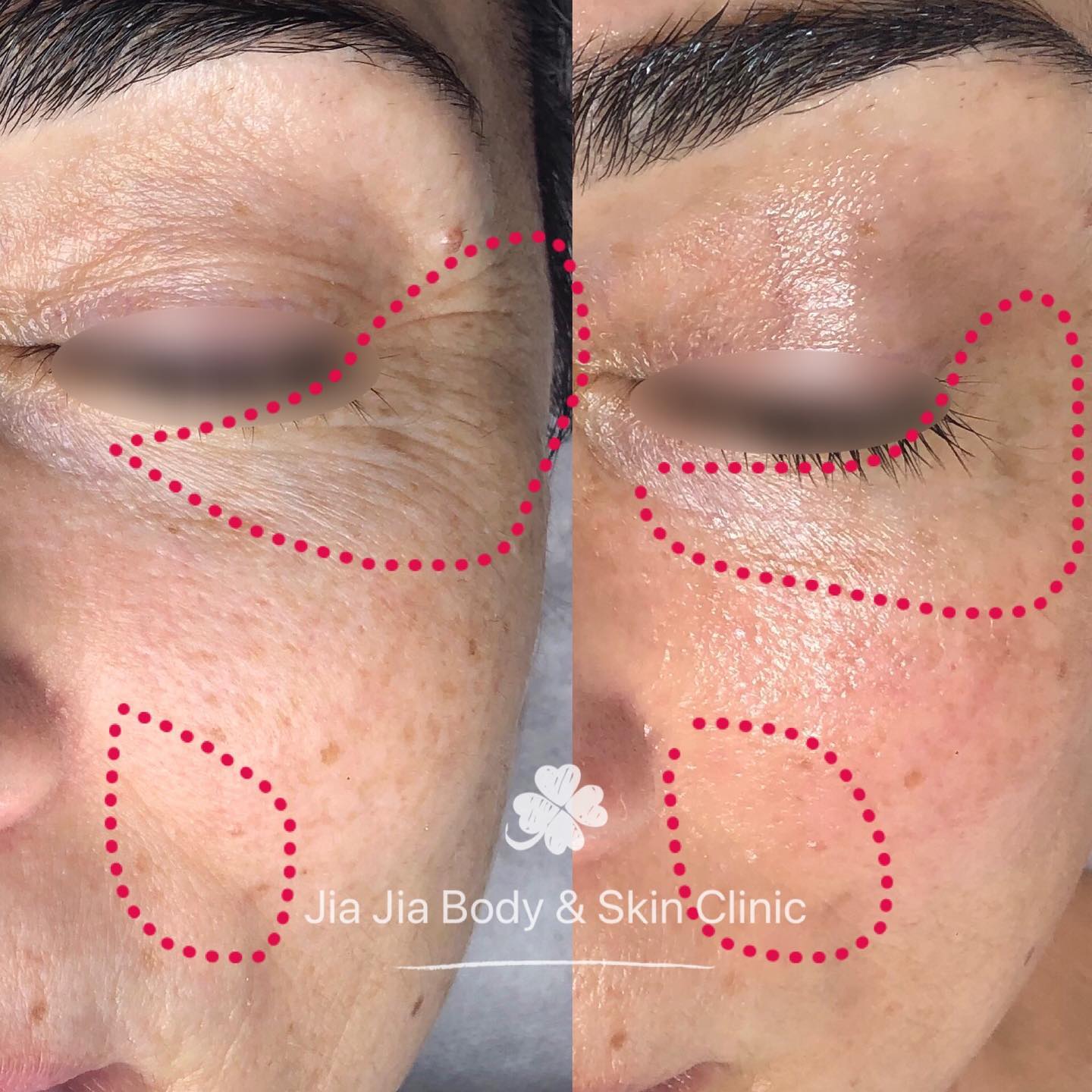 5-day intensive care of skin treatment, you will get firmer, brighter and smoother skin.
We using all-natural ingredients to against your aging!!!
šæVegan friendly šæ
#jiajiabodyandskinclinic
#naturalskincare #herbalmedicine
#veganskincare
#skintightening