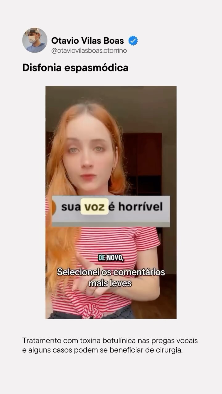 A disfonia espasmódica é um distúrbio da voz que provoca contrações involuntárias das pregas vocais, interferindo na fluidez da fala e impactando de forma significativa a comunicação e a vida social de quem convive com essa condição. Em casos bem selecionados, especialmente quando o tratamento clínico não alcança o resultado esperado, opções cirúrgicas podem ser avaliadas.
O vídeo da criadora @leticiamassensini traz um relato importante e contribui para a conscientização sobre o tema, mostrando como informação e visibilidade também fazem parte do cuidado.
O tratamento mais utilizado atualmente é a aplicação de toxina botulínica nas pregas vocais, que ajuda a reduzir os espasmos e melhorar a qualidade da voz.
Informação correta, empatia e acompanhamento especializado fazem toda a diferença no manejo da disfonia espasmódica.
Crédito do vídeo: @leticiamassensini
