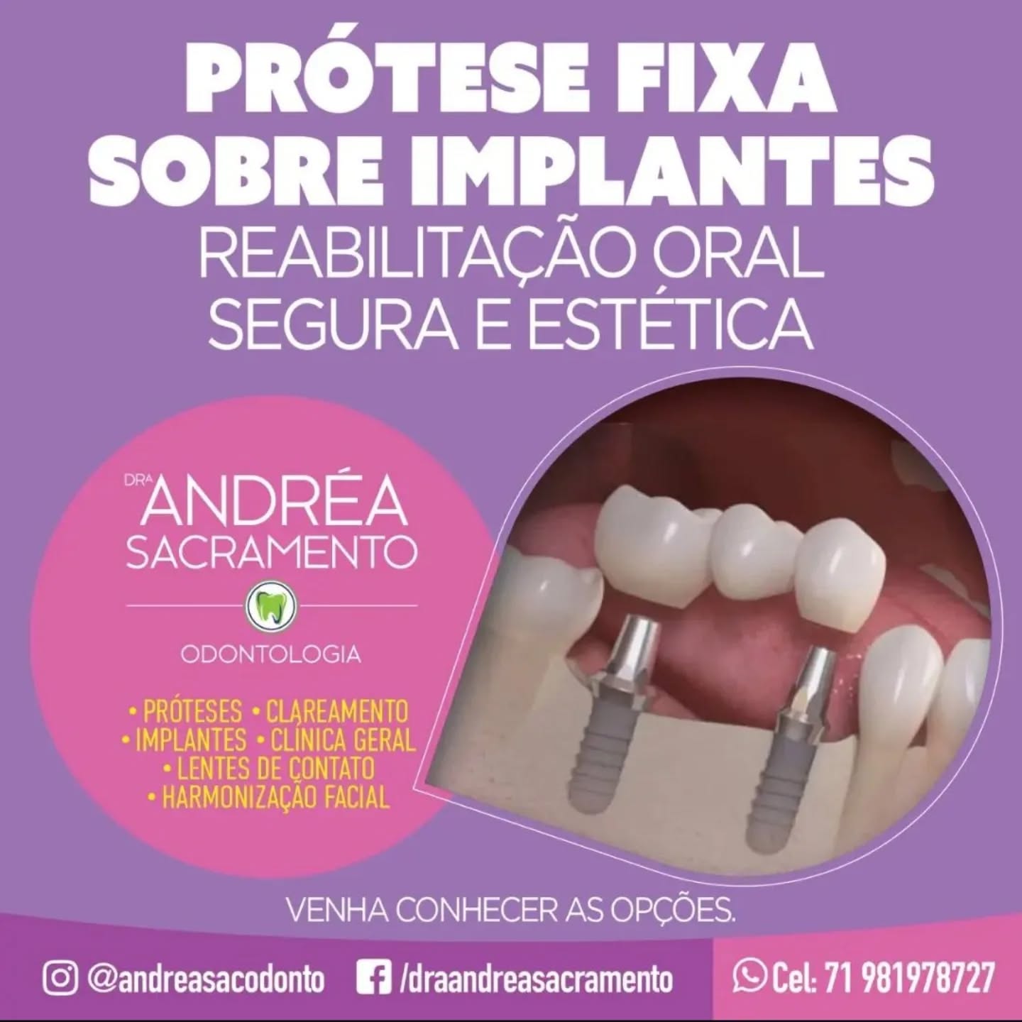 Uma opção maravilhosa para reconstituir seu sorriso e mastigação #proteseprotocolo #dentistasalvador #estetica #saudebucal #harmonizaçaofacial #clareamento #gengivoplastia #acidohialuronico #botoxsalvador #leparcsalvador #alphavillesalvador #brisassalvador #greenvillesalvador