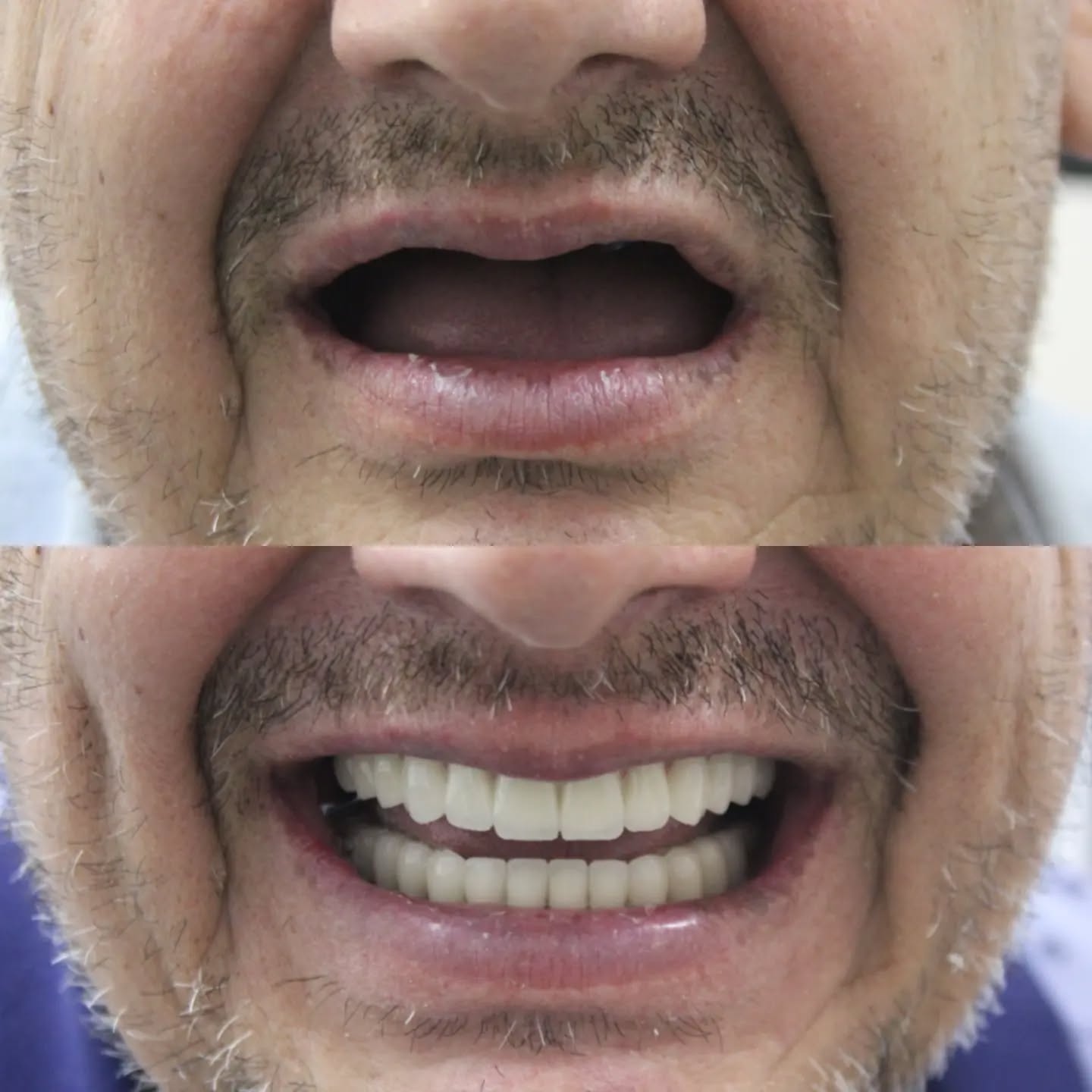 Hastamıza alt ve üst çene implant üstü sabit protez yapılmıştır 🌼
.
.
.
.
.
.
.
.
.
.
.
#izmirdişhekimi #bayraklıdiş
#bornovadiş #bornovadişhekimi #bayraklıdişhekimi #dentalimplants #implant #dişhekimiizmir #izmirdişkliniği #zirkonyumdiş #lamineveneer #kompozitdolgu #kanaltedavisi #zirkonyumkaplama #laminediş #porselenveneer #bleaching #dişbeyazlatma