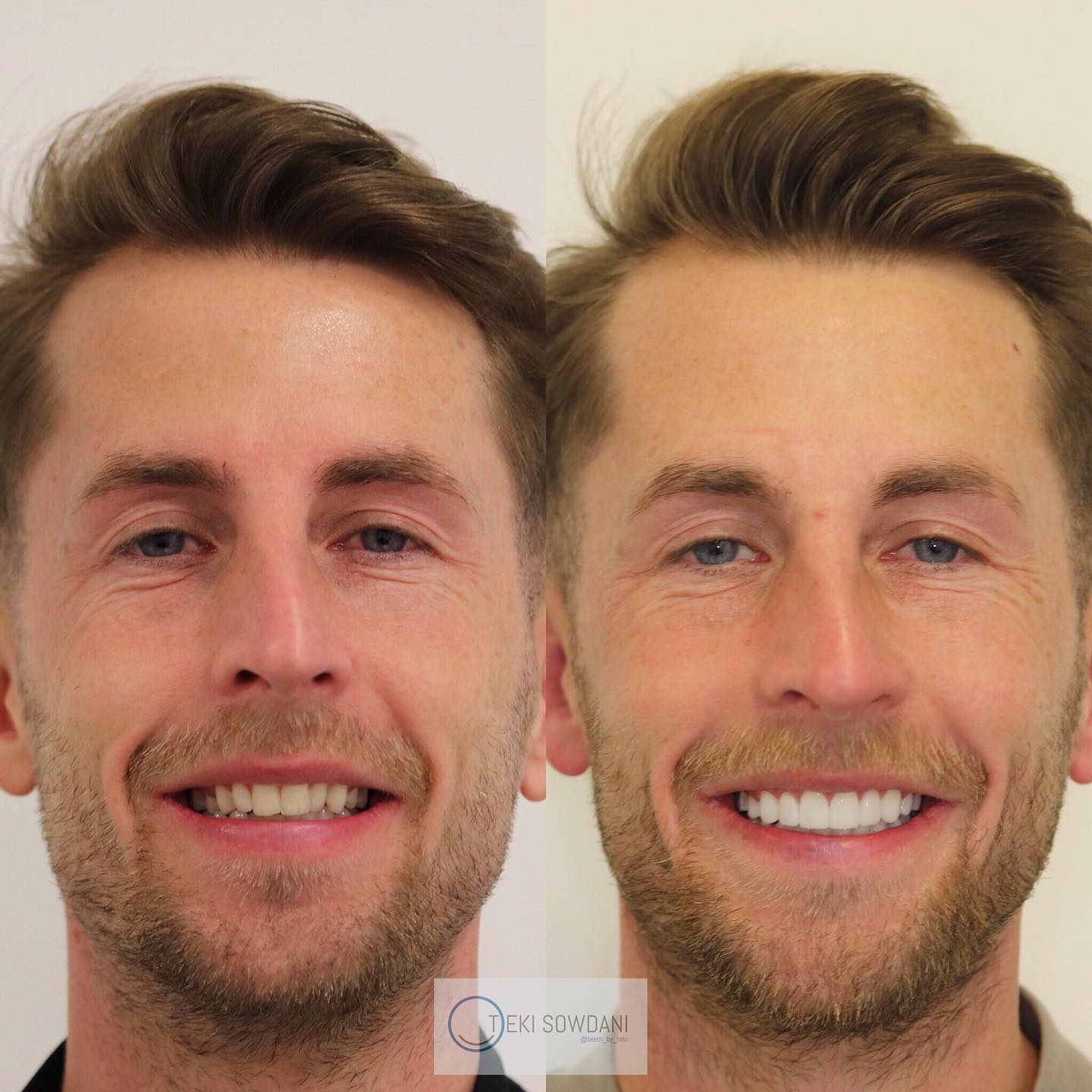 Invisalign + Whitening + Composite bonding ⚪️💙
.
.
You don’t have to file teeth to get a smile like this .
.
#teethbyteki #invisalign #compositebonding #worththewait