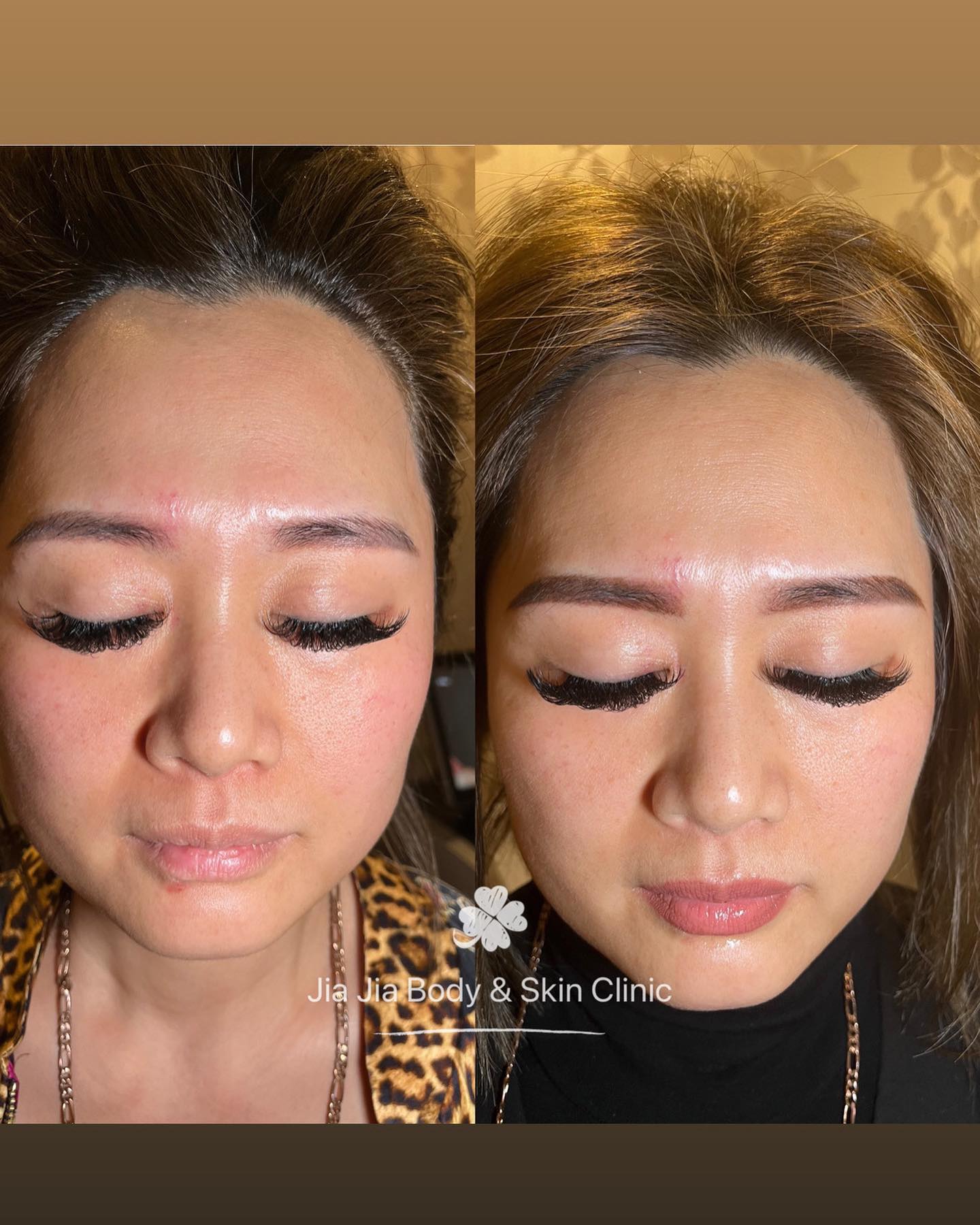 5 days after clear-lift treatment
skin rejuvenation skin tightening even skin tone