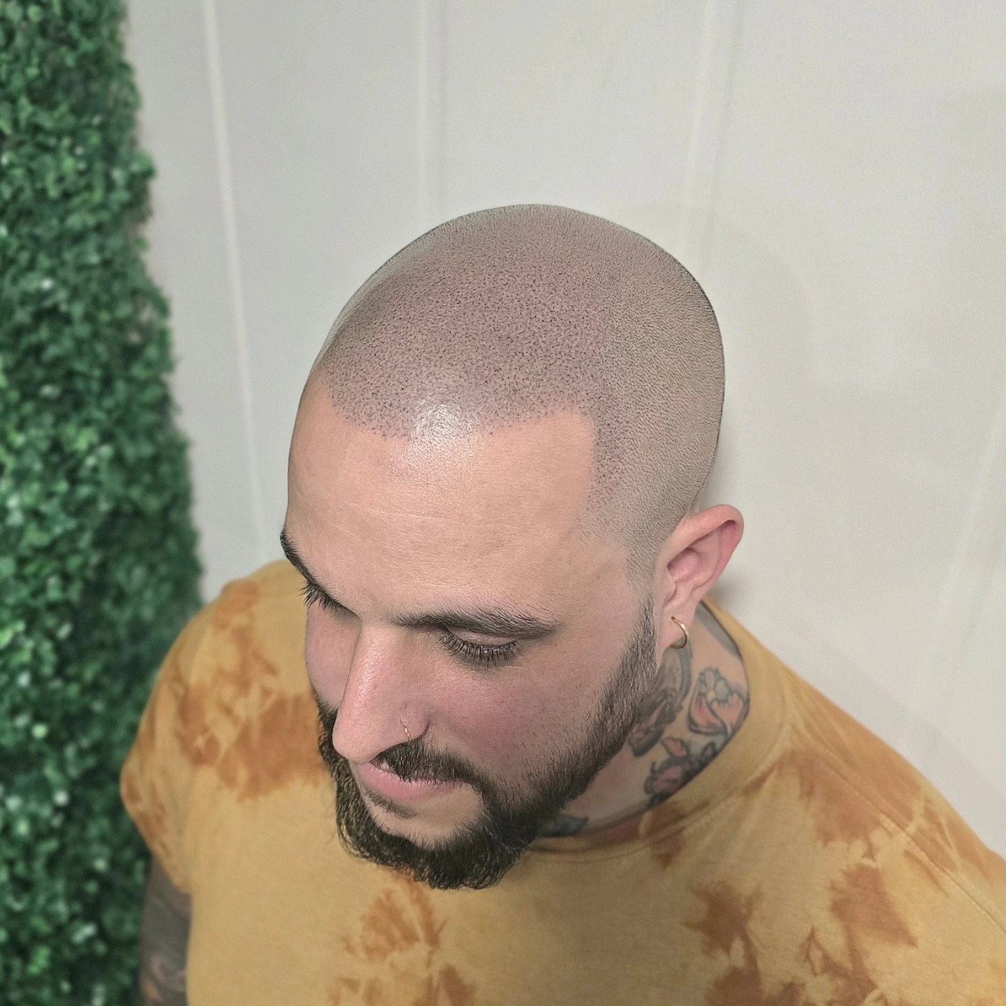 THIS IS NOT REAL HAIR!
Scalp Micro-Pigmentation (SMP) at its finest!
Great to be able to take a photo where there is little redness so you can really see what the 'hair' looks like! (Taken after 3rd and final session)
Thousands of details creating the realistic look of shaved head of real hair! Blended into client's existing hair
Very low maintenance, although obviously have to keep on top of shaving your head for best results
📍Bury St Edmunds
£850 (full head, 3 sessions)
Very competitive prices! Fixed price lifetime top ups!
End hair loss today with a DM
www.skinheadstudios.co.uk
#hairtattoo #hair #menshair #hairloss #scalptreatment
#scalppigmentation #scalpmicropigmentation #smp #cosmetictattoo #beauty #hairgrowth #regrowhair #hairtransplant #recedinghairline #bald #balding #alopecia #malepatternbaldness #aga #maa #pmu #smpu #artist #tattoo #buzzcut #shave