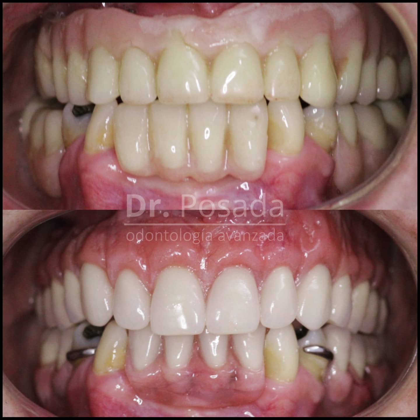 Tener la oportunidad de mejorar y cambiar la vida de nuestros pacientes es nuestro mayor regalo, hoy les presentamos una #solución ideal, las prótesis fijas sobre implantes: son 100% personalizadas, estéticas, funcionales y cómodas. #antesydespues @dr.posada
.
.
.
👨⚕️Agenda tu cita sin costo #valoracion ☎️☎️☎️6017552046📲📲📲3046529022
.
.
.
.
.
.
.
.
#protesishibrida #implantedental #implantologiaoral #dentalcolombia #dentalimplant #dentallaboratory #diseñodental #perdidadental #esteticadental #dentalart #dentist #odontologoscolombia #implantesdentalescolombia #topdoctors #dentaltourism