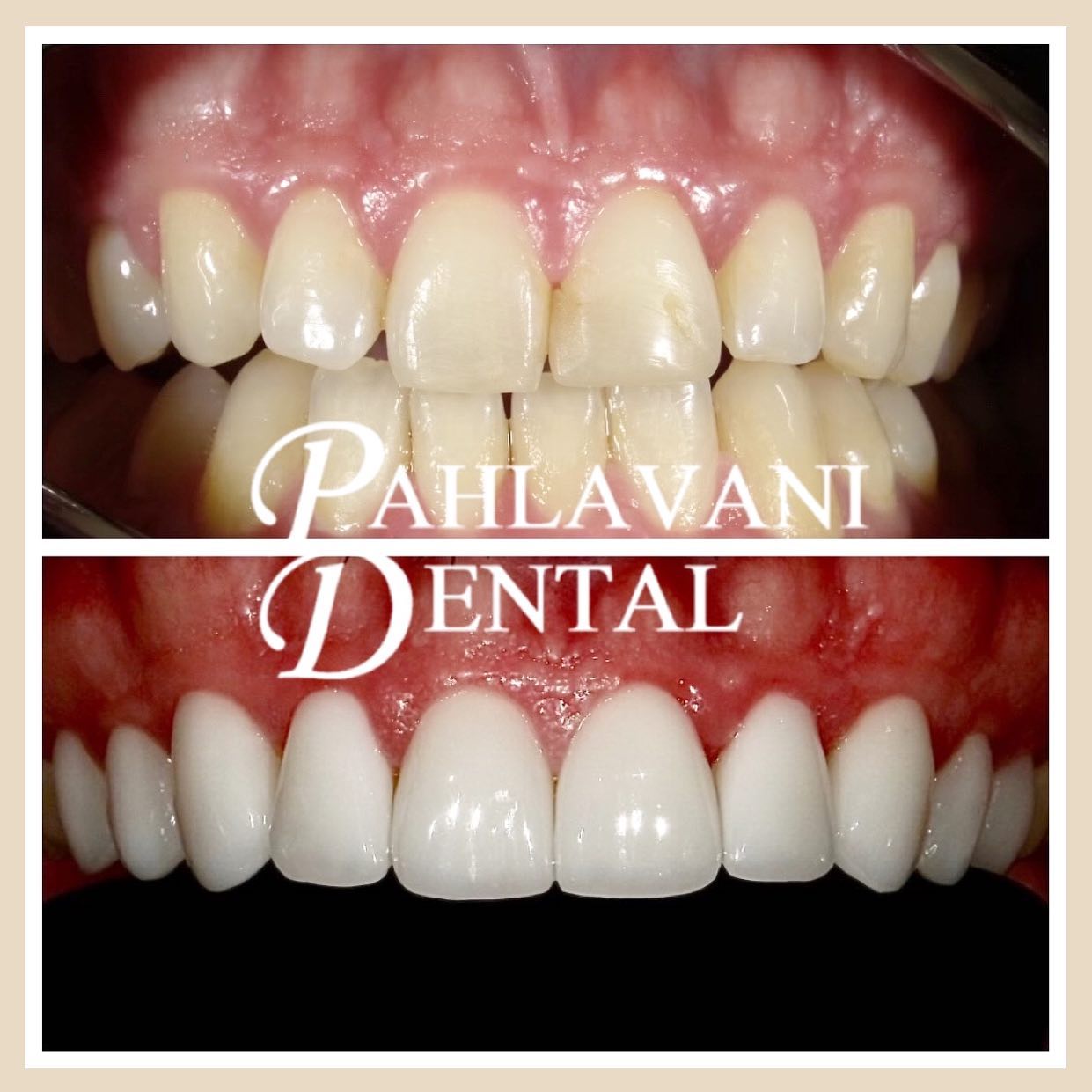 This is how we do it at Pahlavani Dental!🥊✨🔥
Our dear patient wanted to upgrade his smile and we delivered!
Using state of the art technology combined with years of experience we gave this patient an upgrade worthy of sharing.
EMAX veneers were placed from premolar to premolar achieving a younger, even and natural smile 😃
If you would like to hear more about veneers, contact us at:
📞: (202)797-0090
📧: info@pahlavanidental.com
🧑💻: www.pahlavanidental.com