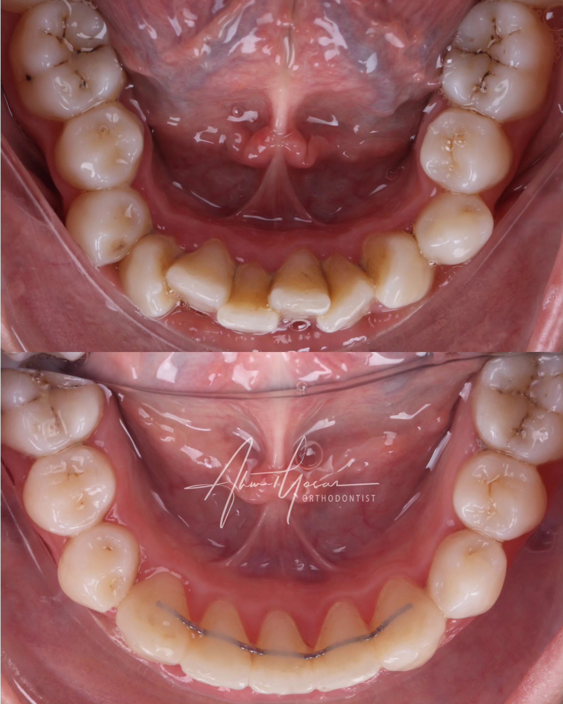 Şeffaf plak / Aligners.
Lower inciser extraction.
.
Our clinic is authorized by the Ministry of Health of the Republic of Türkiye for International Health Tourism. All patients have been informed and have provided consent for the use of their photographs on our social media platforms. All content shared on social media is intended to inform patients about procedures and should not be perceived as advertising. Outcomes of any surgical or interventional treatment may vary from person to person. It is recommended to consult your physician for detailed information before undergoing any procedure.
.
.
.
#ortodonti #ortodontist #bursa #bursaortodonti #bursaortodontist #bursaortodontiuzmanı #orthodontics #braces #teltedavisi #dişteli #orthognathicsurgery #invisalign #clearcorrect #şeffafplak #lingualortodonti #dişteli #çeneameliyatı #selfligating #kapaklıbraket #gülüştasarımı #dent #dentistry #photography #estetik #dentalart #ahmetyasar #drahmetyasar