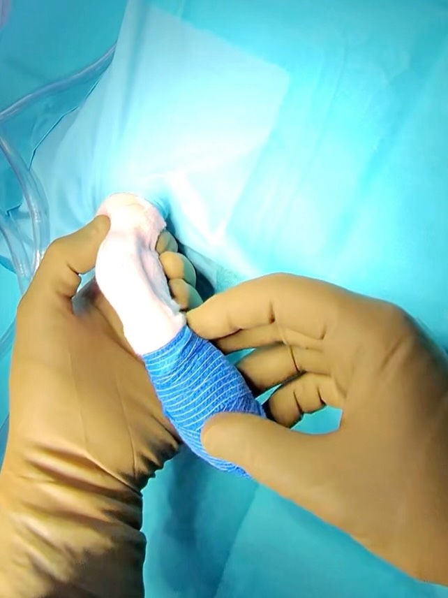 forelimb alignment before and after angular deformity correction for excessive radial procurvatum and internal torsion of the carpus