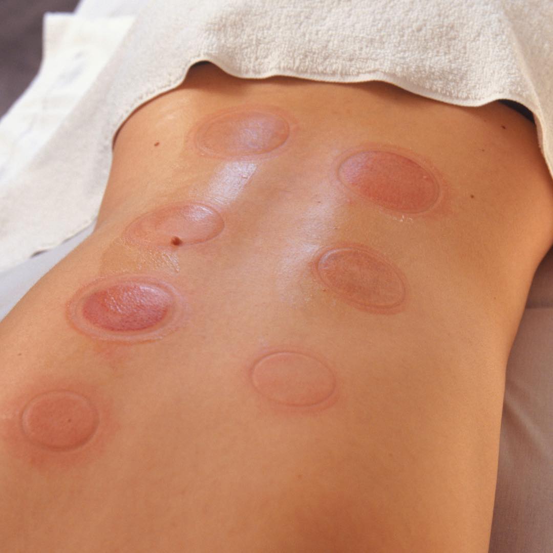 Cupping marks can look like bruises but are not true bruises. The marks are a result of broken capillaries under the skin’s surface caused by the vacuum of the cup. They don’t hurt and typically heal within a week. The body’s immune system is stimulated to help heal the broken capillaries and blood flow is increased to the skin and muscles in the area.