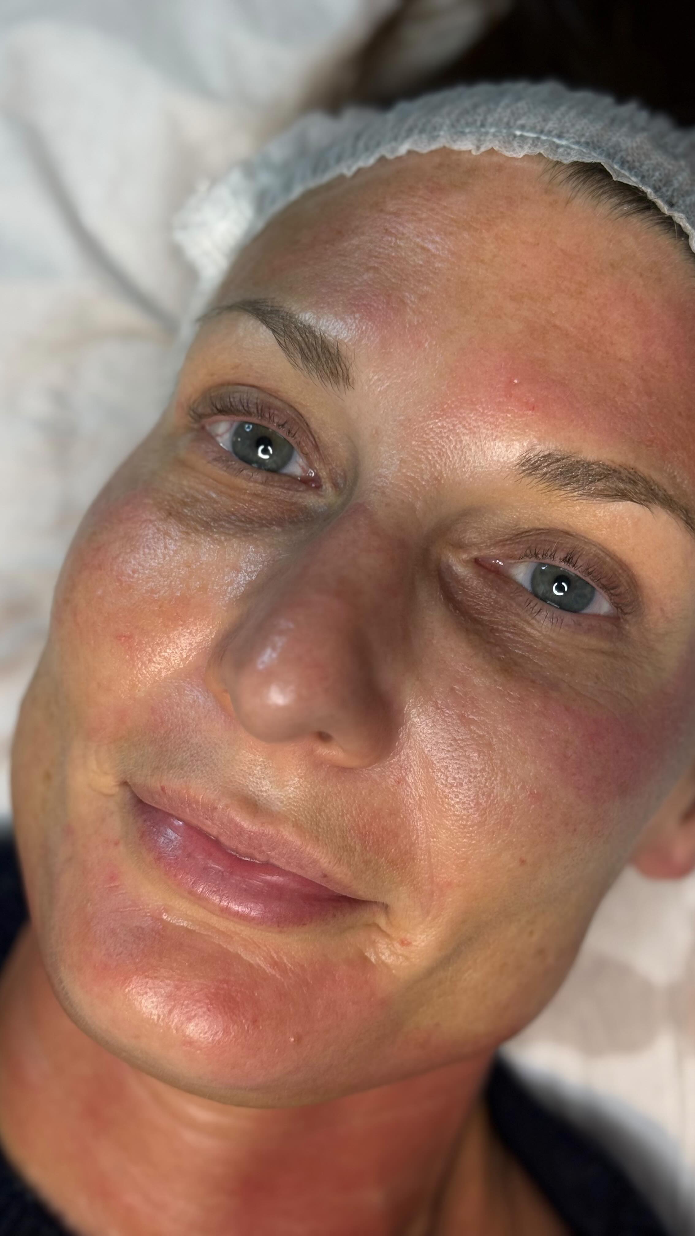 Microneedling transformation âď¸
#salon #cheltenhambeauty #beautysalon #gloucestershire #skincare