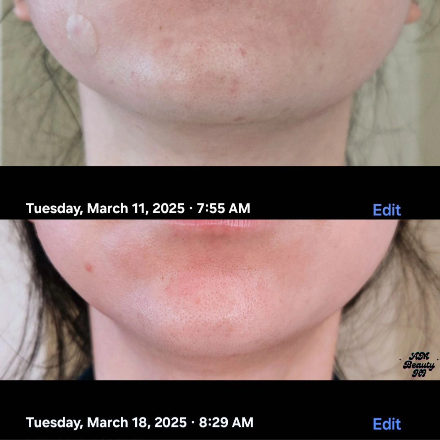 One week of consistency = major results! ✨ Check out this 7-day transformation—clearer, calmer skin with medical-grade skincare + SPF. Because real skincare works when you commit!
📍 Offering virtual skincare consultations with a licensed esthetician—let’s create a routine that works for your skin! 💻✨
#SkincareThatWorks #ClearSkinJourney #VirtualSkincareConsult #LicensedEsthetician #SkincareHelp #EstheticianAdvice #AcneSolutions #GlowUpSkin #HealthySkinIsIn #SkincareRoutine #AcneBreakouts #MedicalGradeSkincare #SPFIsNonNegotiable #SkincareExpert #EstheticianTips #USASkincare #SkincareCoach