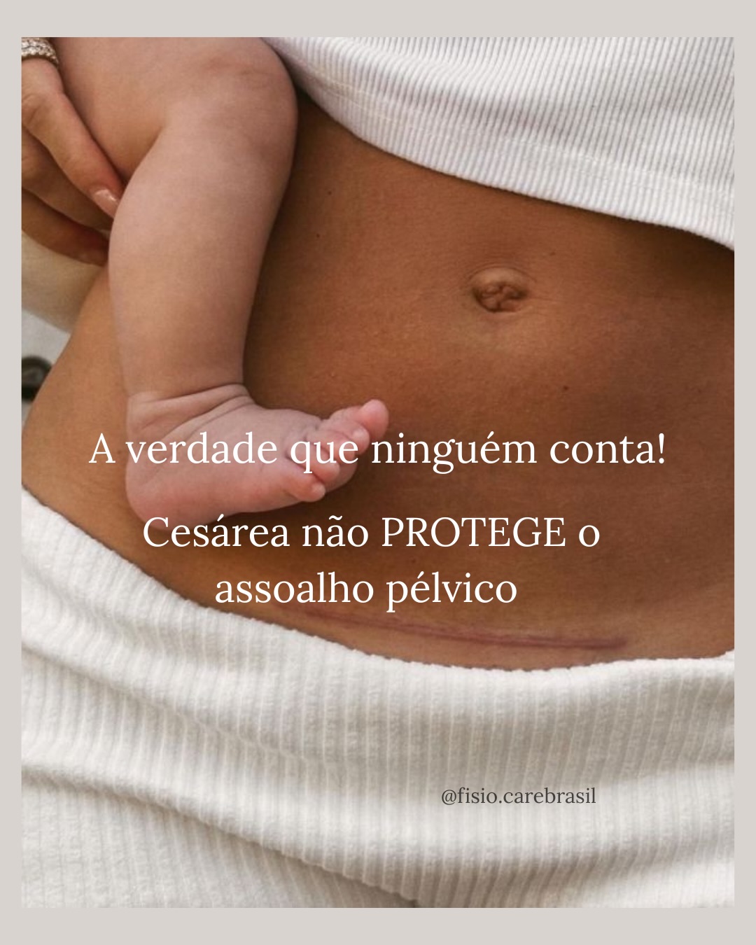 A cesárea não impede disfunções do assoalho pélvico.
O assoalho pélvico sofre adaptações durante toda a gestação:
– peso do útero
– alterações hormonais
– mudanças posturais
– pressão contínua
Além disso, a cesárea é uma cirurgia abdominal
e também impacta músculos, fáscias e controle corporal.
Por isso, cesárea não é garantia de:
• ausência de incontinência
• ausência de dor
• preservação total da função pélvica
O que protege o assoalho pélvico é:
✔️ informação
✔️ avaliação
✔️ acompanhamento adequado
Via de parto não define função.
Função se avalia.
#obstetricía #gineco #fisioterapiapelvica #gestacao #fisiocarebrasil