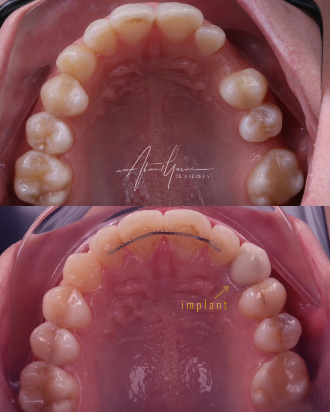 Closing spaces and preparing implant space for missing canine.
.
Dişler arası boşlukların kapatılması ve implant boşluğunun hazırlanması.
.
Our clinic is authorized by the Ministry of Health of the Republic of Türkiye for International Health Tourism. All patients have been informed and have provided consent for the use of their photographs on our social media platforms. All content shared on social media is intended to inform patients about procedures and should not be perceived as advertising. Outcomes of any surgical or interventional treatment may vary from person to person. It is recommended to consult your physician for detailed information before undergoing any procedure.
.
.
.
#ortodonti #ortodontist #bursa #bursaortodonti #bursaortodontist #bursaortodontiuzmanı #orthodontics #braces #teltedavisi #dişteli #orthognathicsurgery #invisalign #clearcorrect #şeffafplak #lingualortodonti #dişteli #çeneameliyatı #selfligating #kapaklıbraket #gülüştasarımı #dent #dentistry #photography #estetik #dentalart #ahmetyasar #drahmetyasar