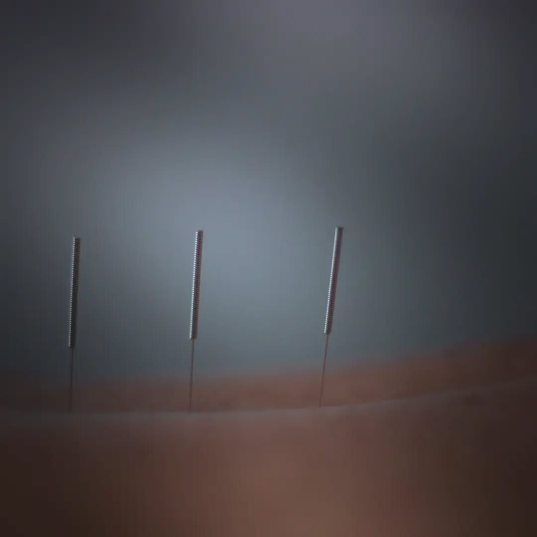 Acupuncture hawkes bay.
#acupuncturehawkesbay #acupuncturenz