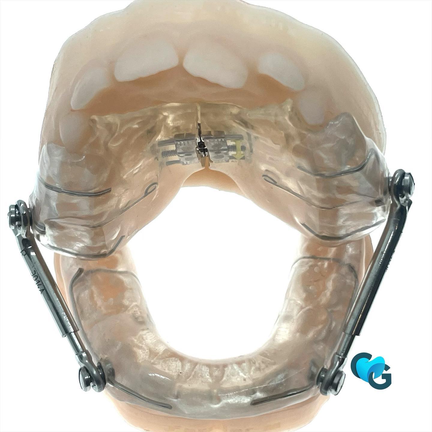 Bielles de Herbst #biellesdeherbst #classe2 #correctiondentaire #dentiste #orthodontie #ortho #ortocolor #ortotooth