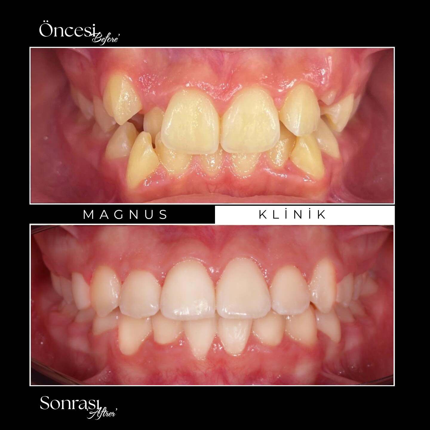 🔹Dişlerde yer darlığı ve çapraşıklık bulunan hastamızın tedavisini sabit tel tedavisi ile tamamladık.
🔹Uzm.Dt @isikortodonti
#ortodonti #ortodontitedavisi #altçenegeriliği #teltedavisi
* Bu paylaşım bilgilendirme amaçlıdır; tanıtım ve reklam niteliği taşımaz.
* Paylaşım yönetmelik gereği yoruma, beğenilere kapatılmıştır.
* Paylaşılan görüntüler, kliniğimizde tedavi gören hastamızın açık rızası alınarak yayımlanmıştır.
* Bu içerik, 12.11.2025 tarihli Resmî Gazete’de yayımlanan Sağlık Hizmetlerinde Tanıtım ve Bilgilendirme Faaliyetleri Hakkında Yönetmelik’in 7. maddesine uygun olarak hazırlanmıştır.
* Her cerrahi veya girişimsel işlemde sonuçlar kişiden kişiye değişiklik gösterebilir. İşlem öncesinde hekiminizden detaylı görüş almanız önerilir.