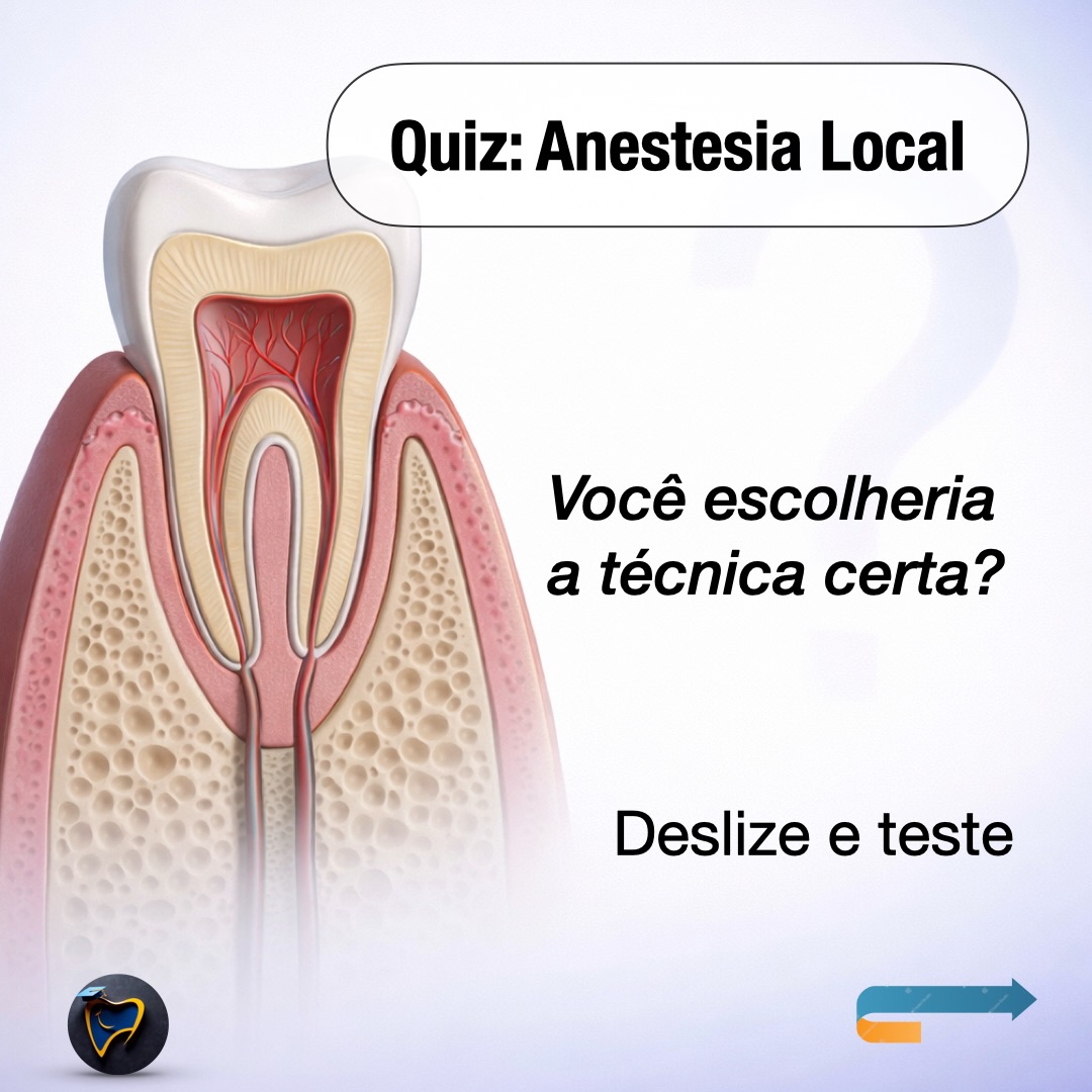 Anestesia local em 6 rotas (e o que cada uma resolve).
Se a dor “escapa”, quase sempre falta estratégia, não anestésico.
✅ Use como mapa rápido:
• Mucosa = conforto na punção
• Submucosa = rotina (especialmente maxila)
• Subperióstica = reforço local
• Intraligamentar = dente-alvo (suplementar)
• Intraóssea = resgate rápido e potente
• Intrapulpar = último recurso
📌 Salve para consultar no consultório.
💬 Qual técnica mais te salva nos casos difíceis?
#endodontia #odontologia #anestesiaodontologica #anestesialocal #dentista