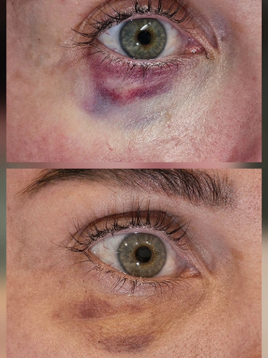 So these pictures were taken 3 days apart. You can see there was swelling and dark purple and then the bruise had already turned yellow by day 3. I used light therapy 2x a day on rejuvenation mode which consists or yellow and red light.
To purchase yours head to themask.co.nz
