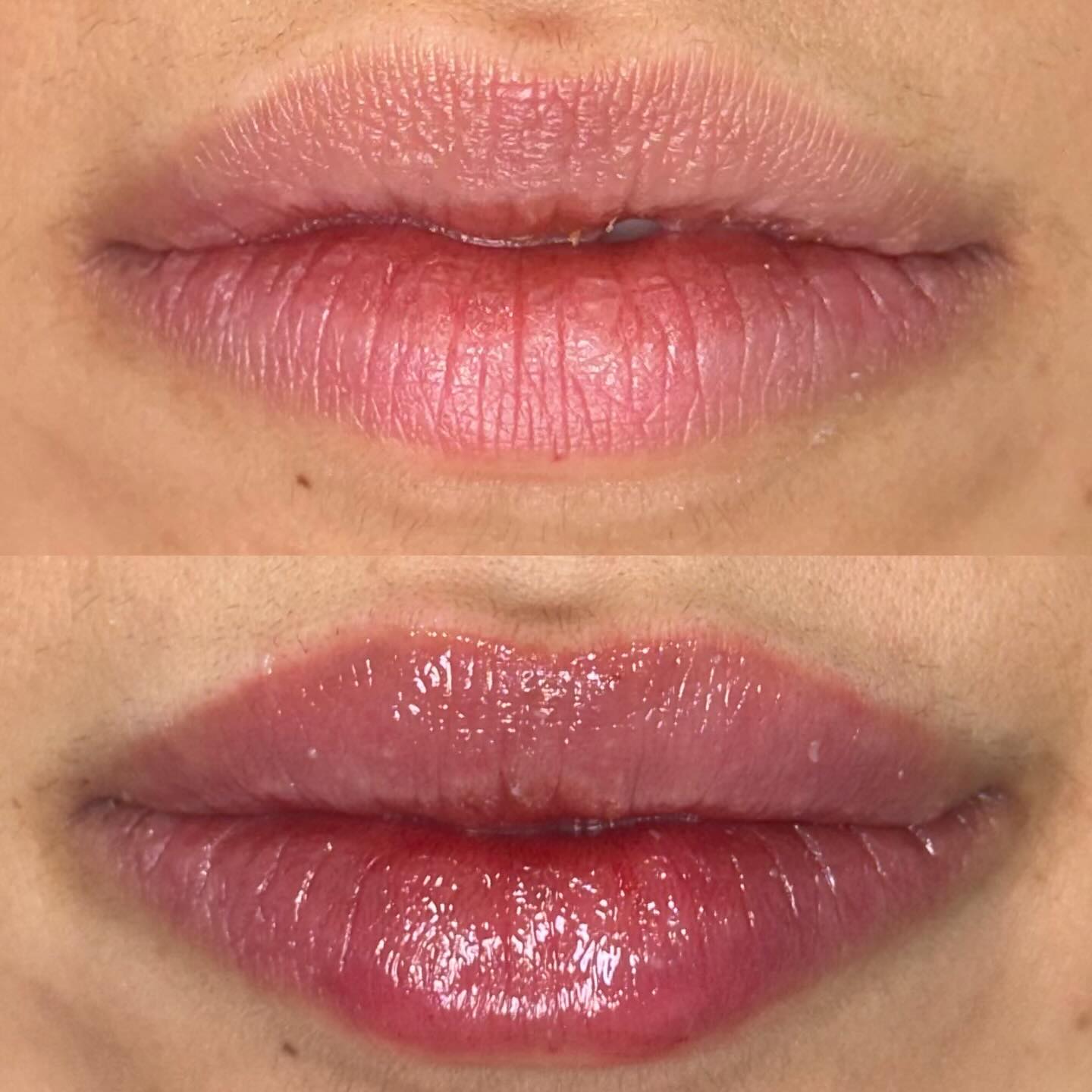 Lip augmentation to restore symmetry, volume and structure to the lips using 0.5ml Restylane Kysse 💋
#lipfillerlondon #naturalaesthetics #naturalfiller #swedishlips