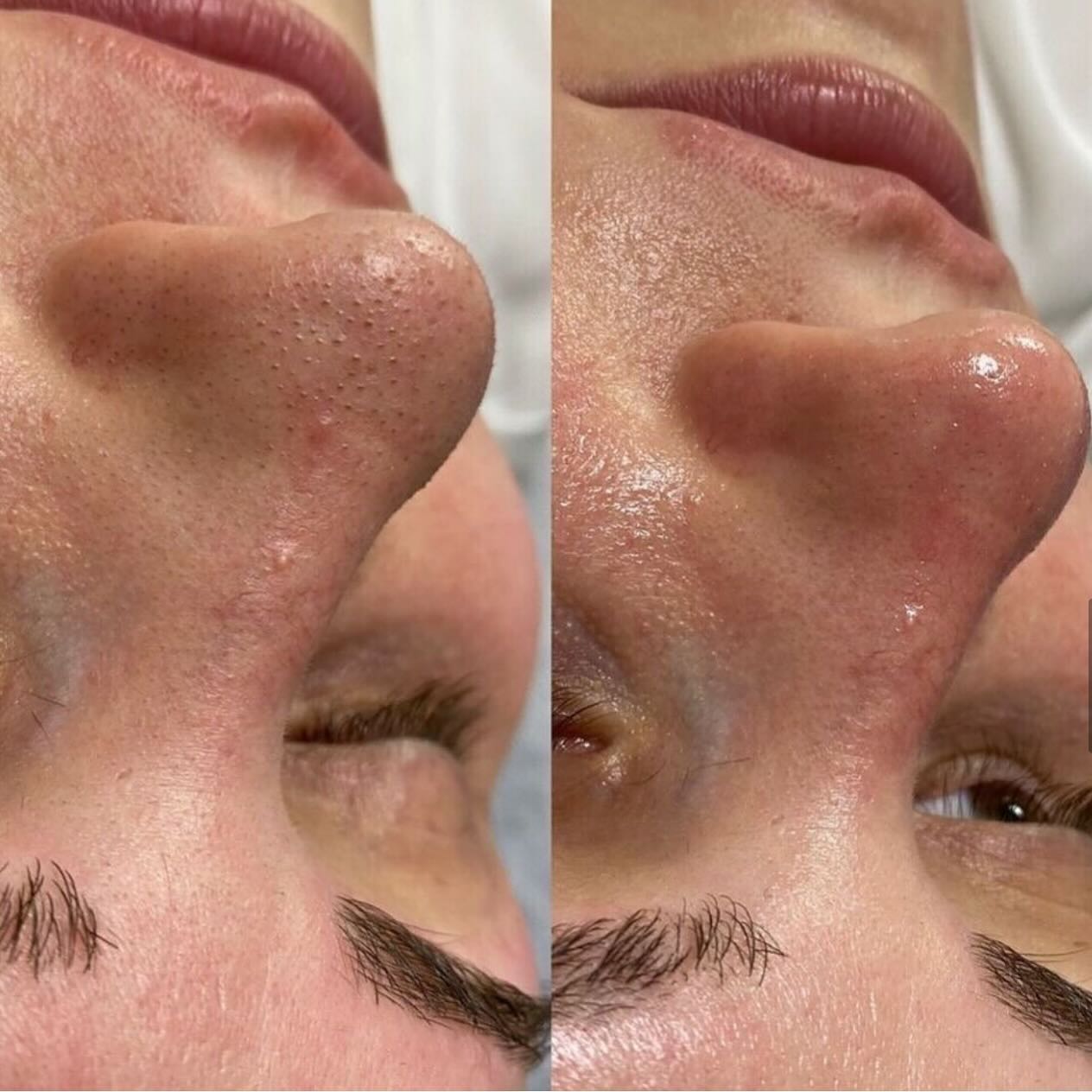 ✨Before & After 1x use of Rooshoor for deep exfoliation on the pores & blackheads.
Sefidab (Scrub and Exfoliate Balls Rooshoor) is a %100 natural and non-chemical cleaner traditionally made of white clay, which is a natural peeling material. It does not consist of any artificial (harmful) materials inside.
It effectively cleanses the skin, exfoliates dead cells, and absorbs excess fat when use it with Kessa Exfoliating Glove.
Traditionally, they used it for cleaning the dead skin, controlling the sweet on the body, making the skin fresh, and controlling the oil on the skin instead of the chemicals that these days use in cosmetics.
Sefidab can also replace the soap for people who have an allergy to soap since it is 100% natural and effective. This traditional product has not been changed in centuries because of its 100% natural ingredients.
#sefidab #rooshoor #rushur #skinexfoilation