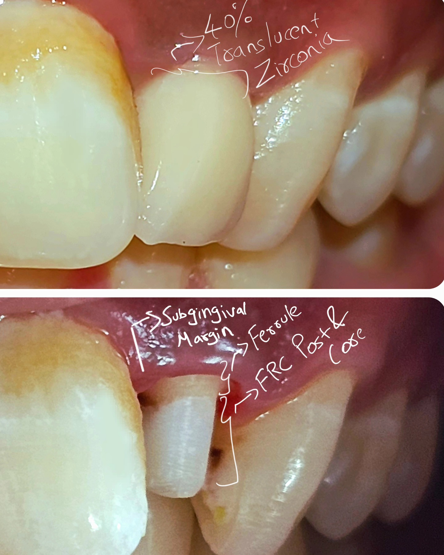 From the eyes of a prosthodontist.
Breaking down the architecture
Restoration of fractured crown with frc post and core and translucent zirconia crown .