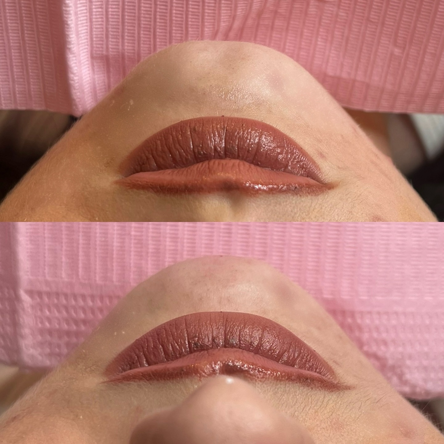 Menton AH 1ML ✨ Cette patiente est venue me voir, gênée par sa faussette au niveau du menton. Elle souhaitait un résultat naturel, tout en douceur, pour harmoniser son profil. 😍