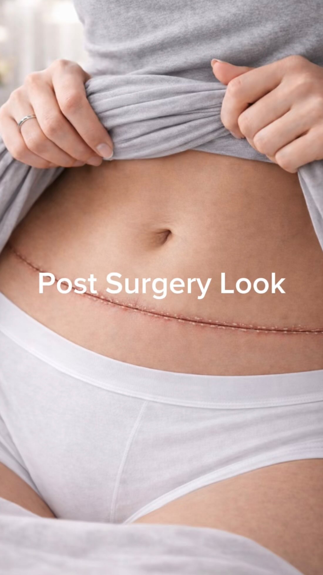 Post surgery look
Bei einer Abdominoplastik verläuft die Narbe so tief, dass sie in der Regel gut durch Unterwäsche oder Bikini verdeckt ist. Zusätzlich bleibt eine feine, unauffällige Narbe um den Bauchnabel ✨
#tummytuck #scar #bodytalk #realresults #aesthetic
