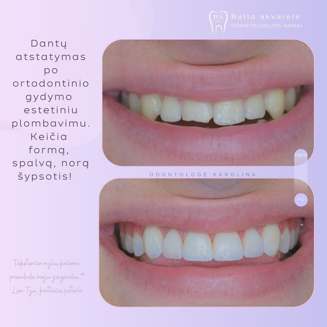 8 dantų plombavimas po dantų tiesinimo.
#estetineodontologija #aesteticdentistry #klinikaklaipedoje #estetinisplombavimasklaipedoje