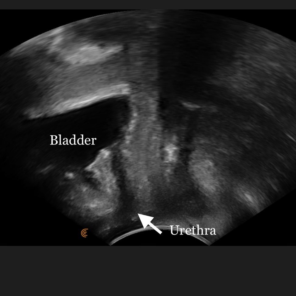 Ultrasound to assess your bladder position and function is key to understanding your leaking. If you haven’t been assessed with transperineal ultrasound, reach out!
#womenshealthphysio #pelvicfloorphysio #incontinence #postpartum #bladder #pregnancy #pelvicfloor #menopause #perimenopause #birthprep #transperineal #ultrasound