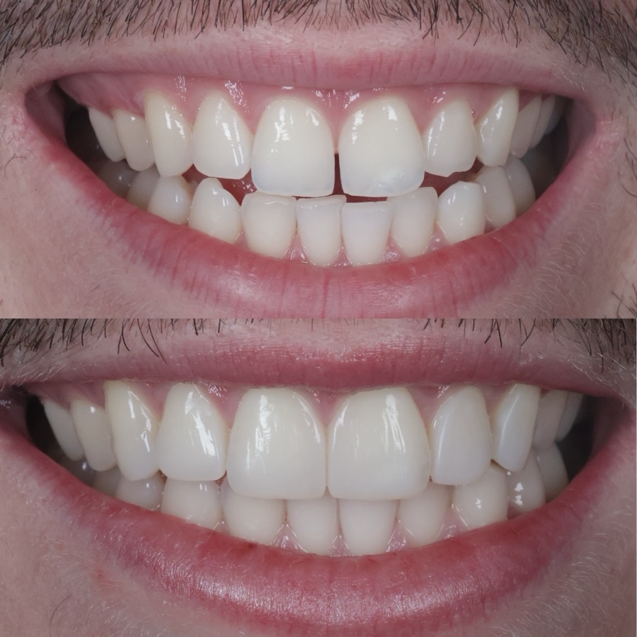 4 teeth naturally composite bonded to close the gap, restore wear, improve proportions — and subtly mask minor misalignment for a more balanced smile.
Palatal composite ramps were added to the patients canines to protect the anterior bonding and optimise function, ensuring this result isn’t just beautiful, but built to last.
DM to start your smile journey ✨