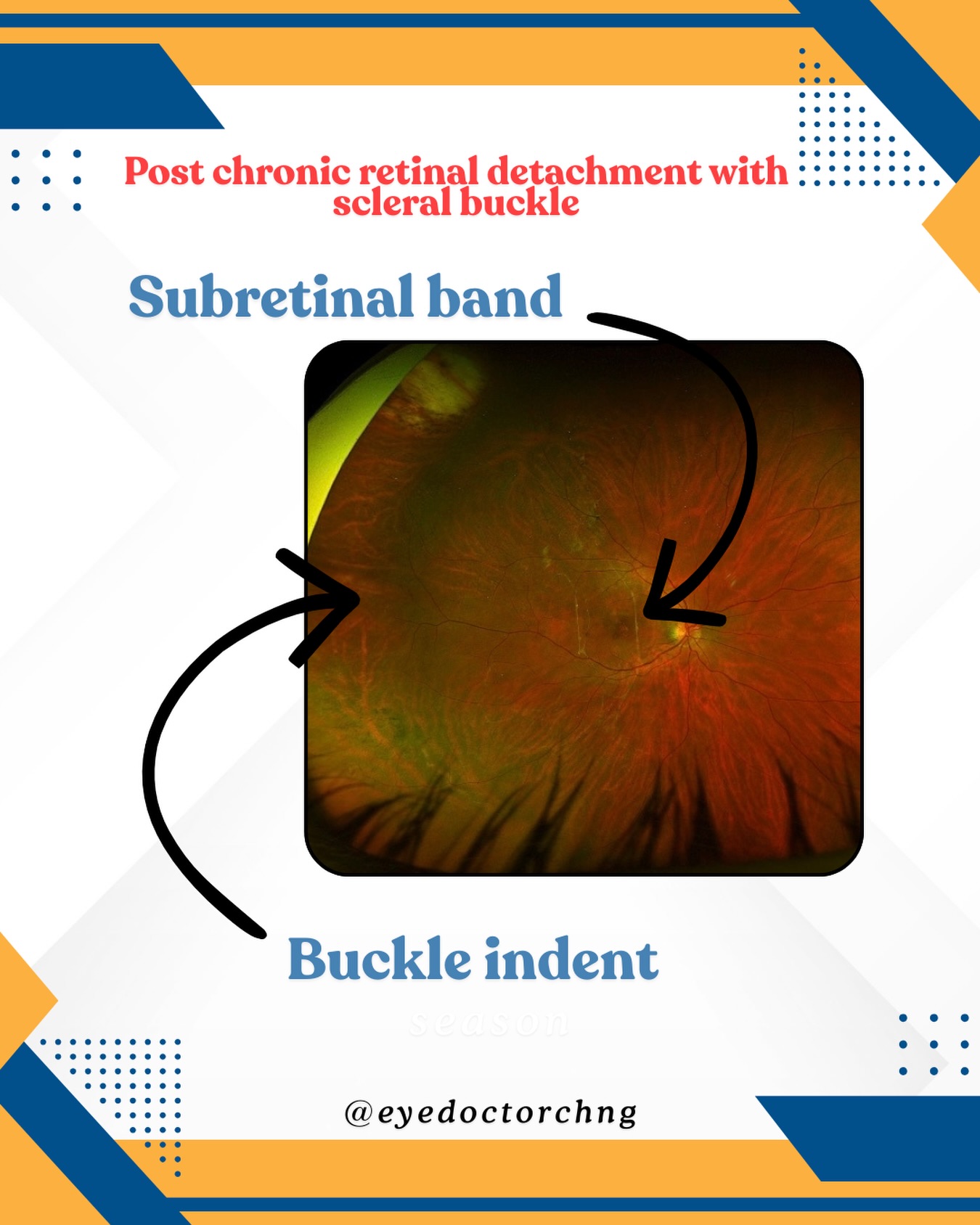 A presentation of a chronic retinal detachment in a young patient a superotemporal hole that was repaired with a 505 scleral sponge buckle. Look at the macular closely and you can see very fine subretinal membranes that indicates chronicity. This case highlights that not all subretinal membranes need to be removed to reattach the retina.
#scleralbuckle #retinaldetachment #vitreoretinal #ophthalmology #eyedoctorchng