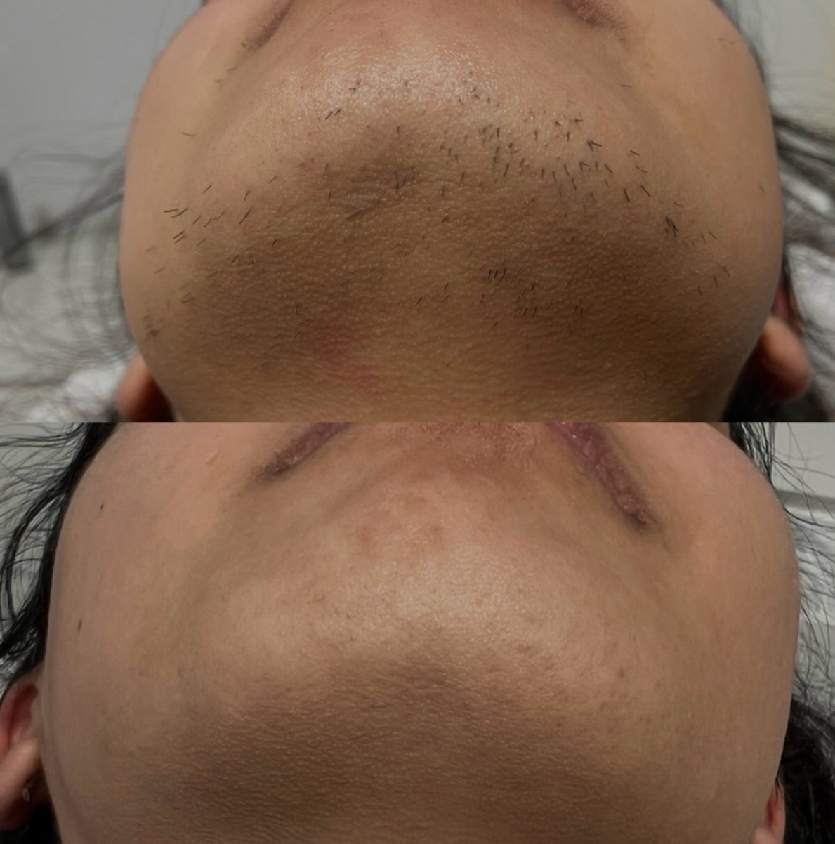 Laser hair removal with PCOS requires a different approach.
Not a quick fix, but with the right plan, it can provide long-term control and noticeable reduction in hair growth.