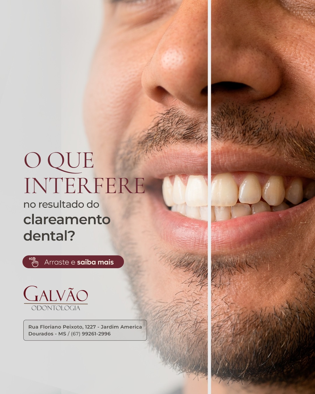 O clareamento dental não é um procedimento padrão para todo mundo.
O resultado depende de vários fatores, desde o tipo de mancha até os hábitos do paciente e a técnica utilizada.
Por isso, nem sempre o clareamento que funcionou para uma pessoa será o mais indicado para outra. A avaliação profissional é fundamental para entender as expectativas, indicar o método correto e garantir segurança durante todo o processo.
Aqui na Galvão Odontologia, o clareamento é sempre planejado de forma individual, respeitando a saúde bucal e buscando um resultado natural.
📲 Agende seu horário na Galvão Odontologia: (67) 99243-1904
📍 Rua Floriano Peixoto, 1227 – Esquina com a Rua Monte Alegre – Jardim América, Dourados – MS
#dentista #odontologia #dourados #douradosms #clareamento #esteticadental #sorriso #saudebucal