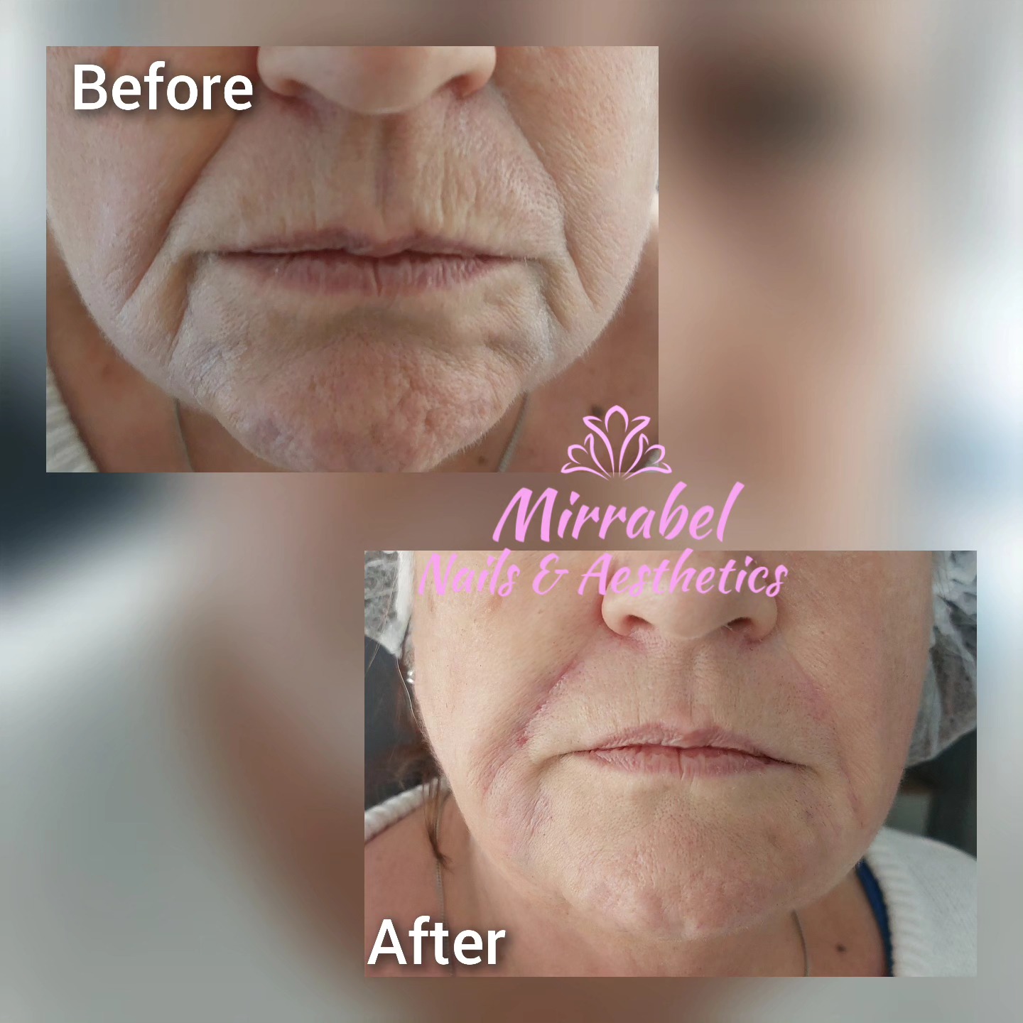 💉 💉 We treated Nasolabial folds and marionette lines with hyaluronic acid filler. Pictures taken before and straight after..💉💉
** free consultation
** 30min treatment
** minimal pain (topical anaesthetic used)
** no downtime
** Instant result which improves within couple of weeks
Hyaluronic acid Fillers replenish volume and stimulate collagen production, minimising the appearance of facial lines, wrinkles and folds for more youthful look.
Book yours 07894536122
#Altrinchamtoday #esthetics #botox #antiwrinkleinjection #Altrincham #halebarns #halemums #hale #wythenshawe #timperleybeauty #timperleybeauty #fillers #nasiolabialfolds #sale #dermalfillers #wrinkles #nasiolabialfiller #nasolabialfold #smokerslinestreatment #marrionettelines