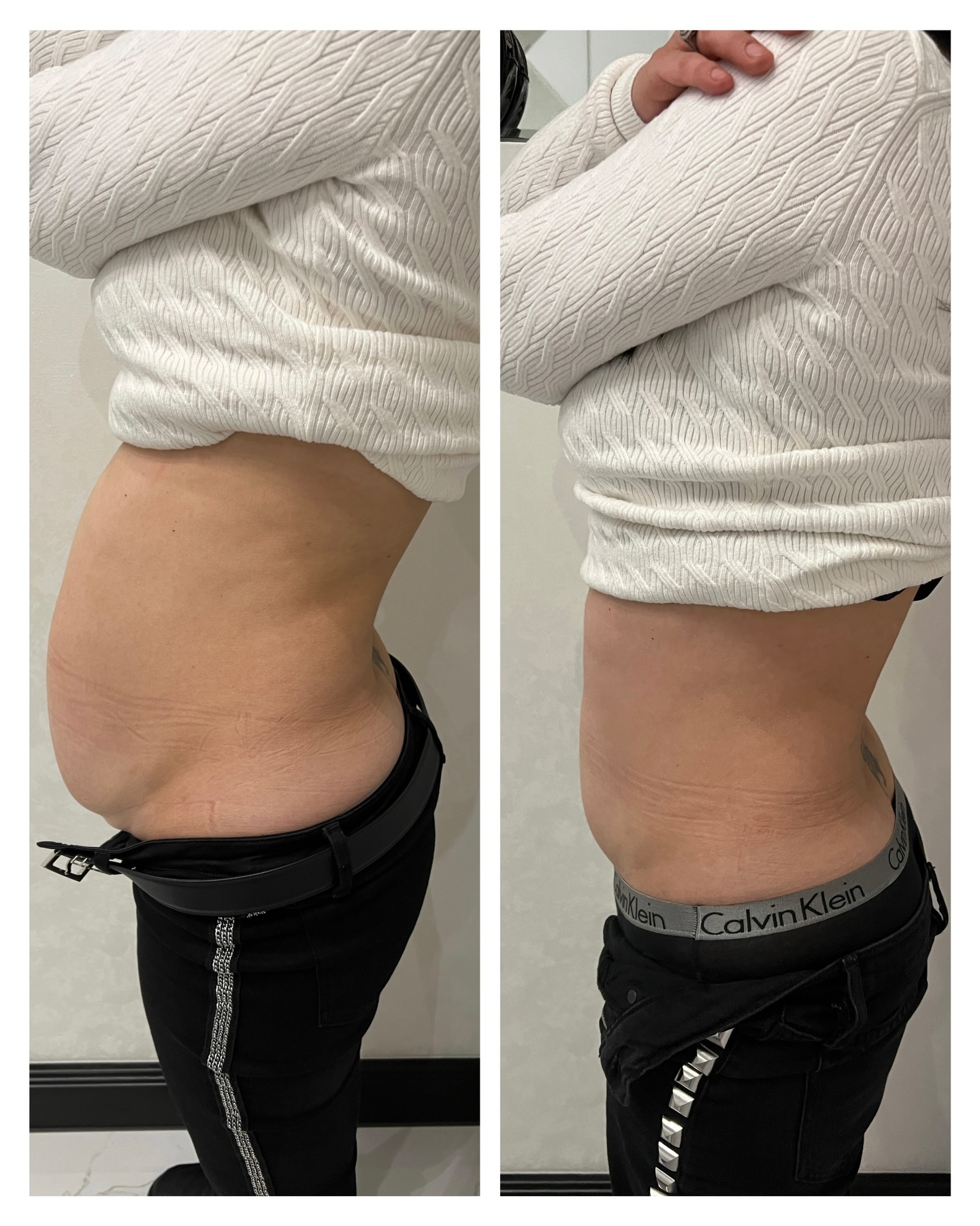 Die Macht von VelaShape3💪🏼
Diese Behandlung reduziert nicht nur deine Fettzellen, aber sie straft auch gleichzeitig die Haut. Das Ergebnis ist nach acht Behandlungen.😍
Wie findest du dieses Ergebnis?