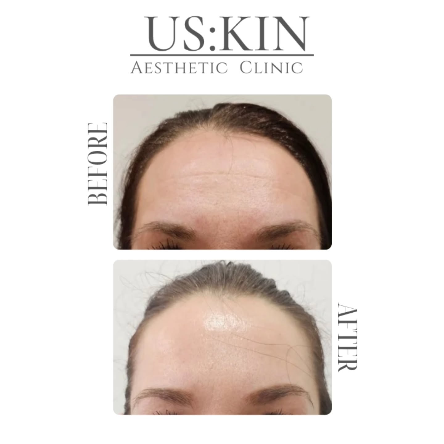 📸The before and after images above, demonstrate the effect of botulinum toxin type A on dynamic facial rhytides caused by repetitive muscle contraction.
🔗Mechanism of action:
Anti-wrinkle injectables work by temporarily inhibiting acetylcholine release at the neuromuscular junction, resulting in targeted muscle relaxation and visible reduction in dynamic wrinkles.
💉Common treatment areas include:
• Glabellar complex (frown lines)
• Frontalis muscle (forehead lines)
• Lateral orbicularis oculi (crow’s feet)
👀What you're seeing in this result:
✔ Reduction in dynamic lines at rest and with expression
✔ Improved skin smoothness
✔ Preservation of natural facial movement
✔ Harmonized facial appearance
✔ No "frozen" look
⏰️Initial effects are typically seen within 3–5 days, with full clinical results at approximately 10–14 days.
📆Duration of effect averages 3–4 months, depending on individual metabolism and muscle activity.
⚕️Preventative application:
Early intervention can reduce the progression of static rhytides and support long-term skin quality by minimizing repetitive mechanical stress on the dermis.
👩🏼⚕️Treatment performed by a trained medical professional; registered Cosmetic Dermatology Nurse & Independent Prescriber - Sandra.
🕐Treatment time: 30-60 minutes
📍Fitzrovia, London
*The treatment performed following medical consultation.
*Images shared with informed consent.
*Results may vary between individuals.
#uskinaestheticclinic #beforeandafterglow #antiwrinkletreatment #dermnurselondon #injectablesjourney
💬 Which area would you most like to learn about?