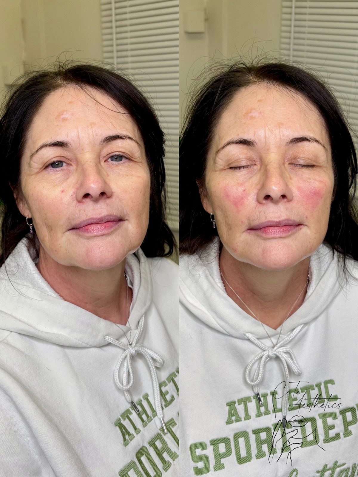 Full Face Rejuvenation with Dermal Filler 🤍
A comprehensive dermal filler treatment designed to restore balance, structure and youthful contours to the face. Key areas treated include the cheeks, nasolabial folds, marionette lines, and jowls. By carefully replacing lost volume and supporting facial architecture, this approach softens lines, improves definition and creates a refreshed, natural-looking result without altering your facial expression.
Our dermal filler packages are tailored to each individual, based on facial anatomy, concerns, and desired outcomes.
Visit www.ceteaesthetics.co.uk to schedule an appointment
——
#dermalfiller #aestheticsscunthorpe #scunthorpebusiness #cheekfillers #northlincolnshirebusiness