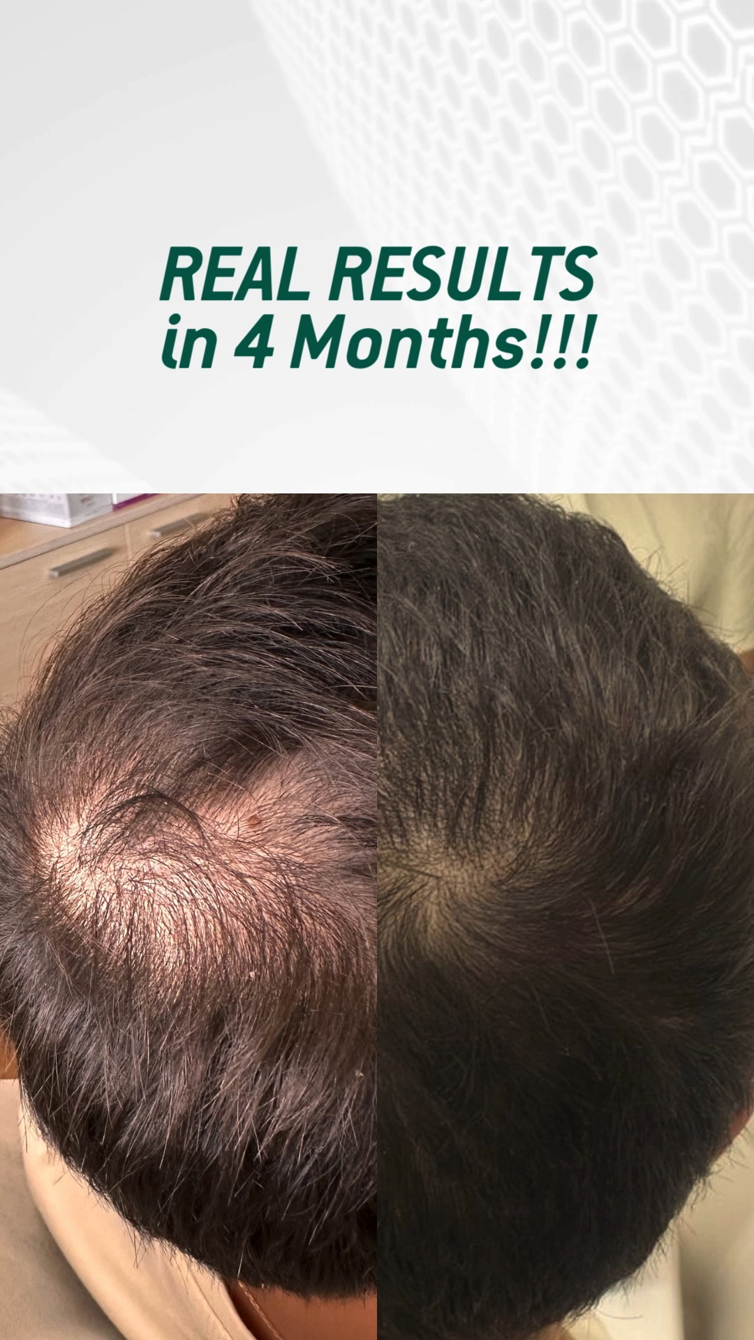 *Αλωπεκία ανδρογενετικού τύπου**
Εξειδικευμένη αγωγή FOLLICURE+ by @stefanos_goudelas
Σχεδιάστηκε για να ενισχύει τη φυσική αναγέννηση της τρίχας και να βελτιώσει την υγεία του τριχωτού. Σε συνδυασμό με εξατομικευμένη αξιολόγηση, μπορεί να προσφέρει ουσιαστικά και μακροπρόθεσμα αποτελέσματα.
Το FOLLICURE+ εφαρμόζεται σε ασφαλές και ελεγχόμενο ιατρικό περιβάλλον, προσφέροντας μια στοχευμένη λύση για άνδρες και γυναίκες που αντιμετωπίζουν τριχόπτωση.
Δείτε περισσότερα εδώ:
https://www.drstefanosgoudelas.com