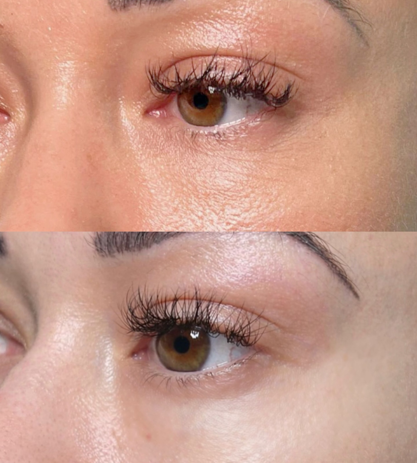 ✨ Under-eye rejuvenation with Polynucleotides ✨
These before & after results show the power of polynucleotide treatment — a regenerative injectable designed to repair and revitalise delicate under-eye skin, rather than simply fill it.
💉 Benefits of Polynucleotides:
• Stimulate cellular repair and tissue regeneration
• Improve skin quality, elasticity, and thickness
• Reduce the appearance of fine lines, crepiness, and dark circles
• Enhance hydration and overall skin vitality
• Perfect for the fragile under-eye area where traditional fillers aren’t suitable
Polynucleotides work by encouraging your skin to heal, strengthen, and function better over time — resulting in natural, refreshed, and long-lasting improvement ✨
📆 Treatment plan:
An initial course of 3 sessions is recommended, followed by maintenance every 6–9 months to preserve results.
📍Book your consultation at www.doctorbianca.co.uk
#DoctorBianca #Polynucleotides #UnderEyeRejuvenation #RegenerativeAesthetics #NaturalResults AdvancedInjectables SkinQuality AestheticDoctor