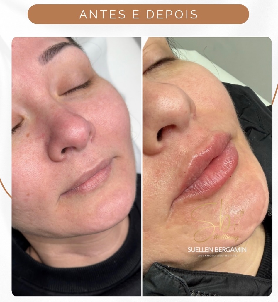 Às vezes, o medo não é do procedimento.
É de não se reconhecer depois.
Por isso, o preenchimento labial que eu faço para as minhas clientes não é padrão.
É personalizado, pensado para o seu rosto e para quem você é.
O procedimento é tranquilo, feito com cuidado, técnica e sem exageros.
📲 Agende sua avaliação: 📲 +44 7398 192413
Me siga no Insta: https://abrir.link/wVTdf
.
Sometimes the fear isn’t the procedure itself.
It’s not recognizing yourself afterward.
That’s why the lip filler I perform for my clients is never standard.
It’s personalized — designed for your face and for who you are.
The procedure is calm, carried out with care, technique, and without exaggeration.
📲 Book your consultation: +44 7398 192413
Follow me on Instagram: https://abrir.link/wVTdf #london #lipfillers #brazillondon #hammersmith