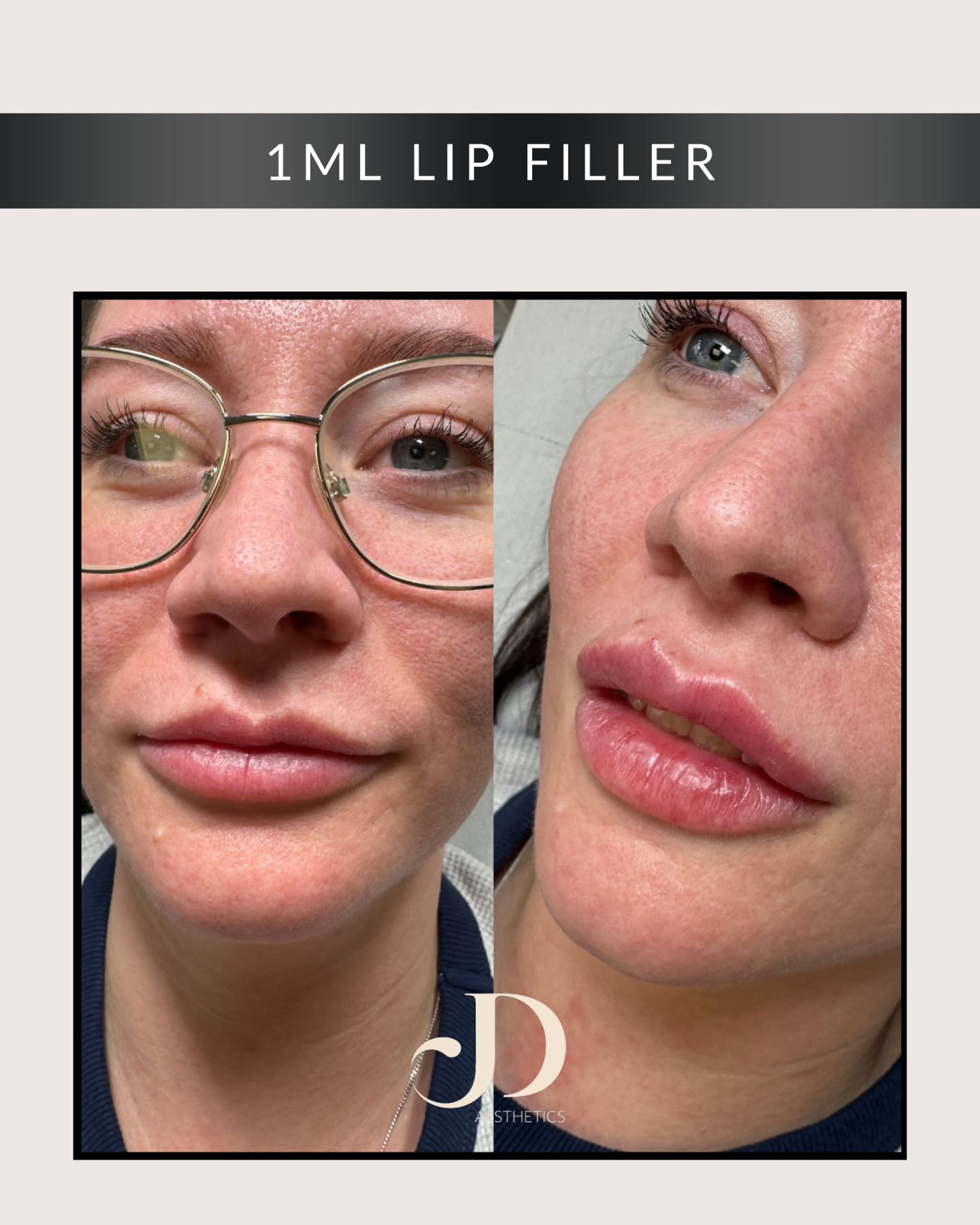 🔥🤍 1ML LIP FILLER RESULTS 🤍 🔥
1ml lip filler results for my client—soft, natural, and beautifully enhanced.
Gently balanced to complement her features while maintaining a natural look.
Subtle. Smooth. Beautiful.
#lipfiller #1mllips #naturallipfiller #lipfillerscheshire #lipfillerswarrington