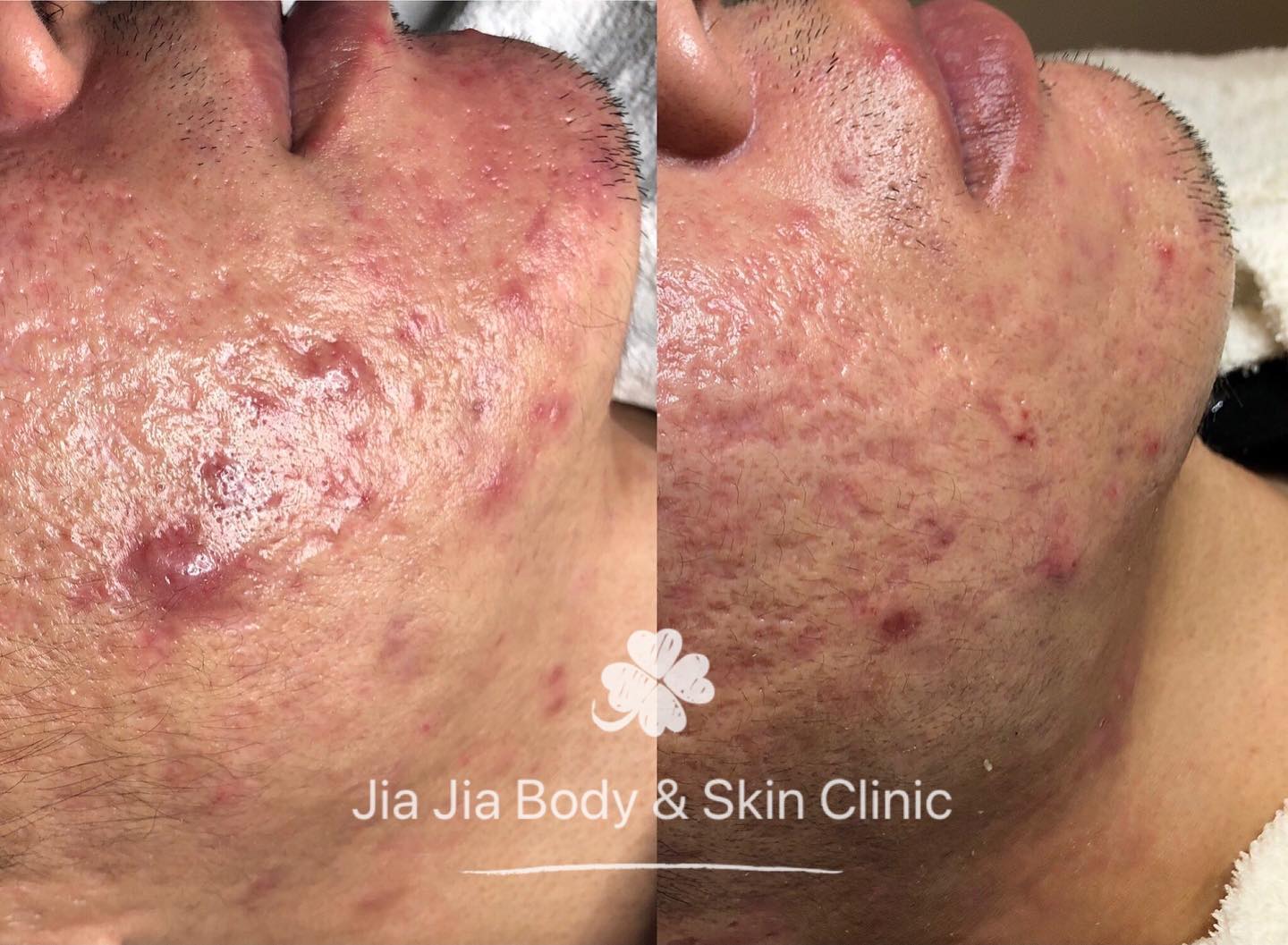 Results from one time of Jia Jiaās Signature Acne treatment
#acnetreatment #acne #SGA #jiajiabodyandskinclinic