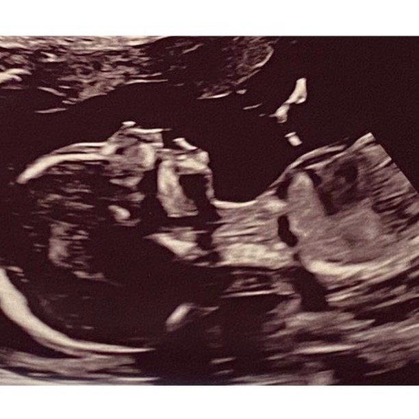this is what a 2D scan looks when your baby is 20 weeks
#obstetrician #fetalmedicine #obstetrics #antenatal #2dscan #anomalyscan #fetalmedicine #obstetrician #privateobstetrics
@eileithyia_maternity
@chelwestprivatecare
@chelwestft