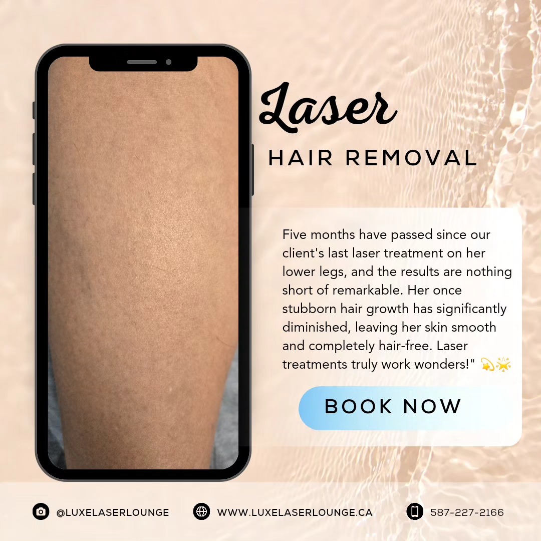 Unveil smooth perfection. 💫✨ Say goodbye to unwanted hair with laser treatments.
Lower legs $175/treatment
#LaserHairRemoval #BeautyGoals #SkinConfidence #yyclaserhairremoval
#calgarybrides #calgarylaserhairremoval #yycbride