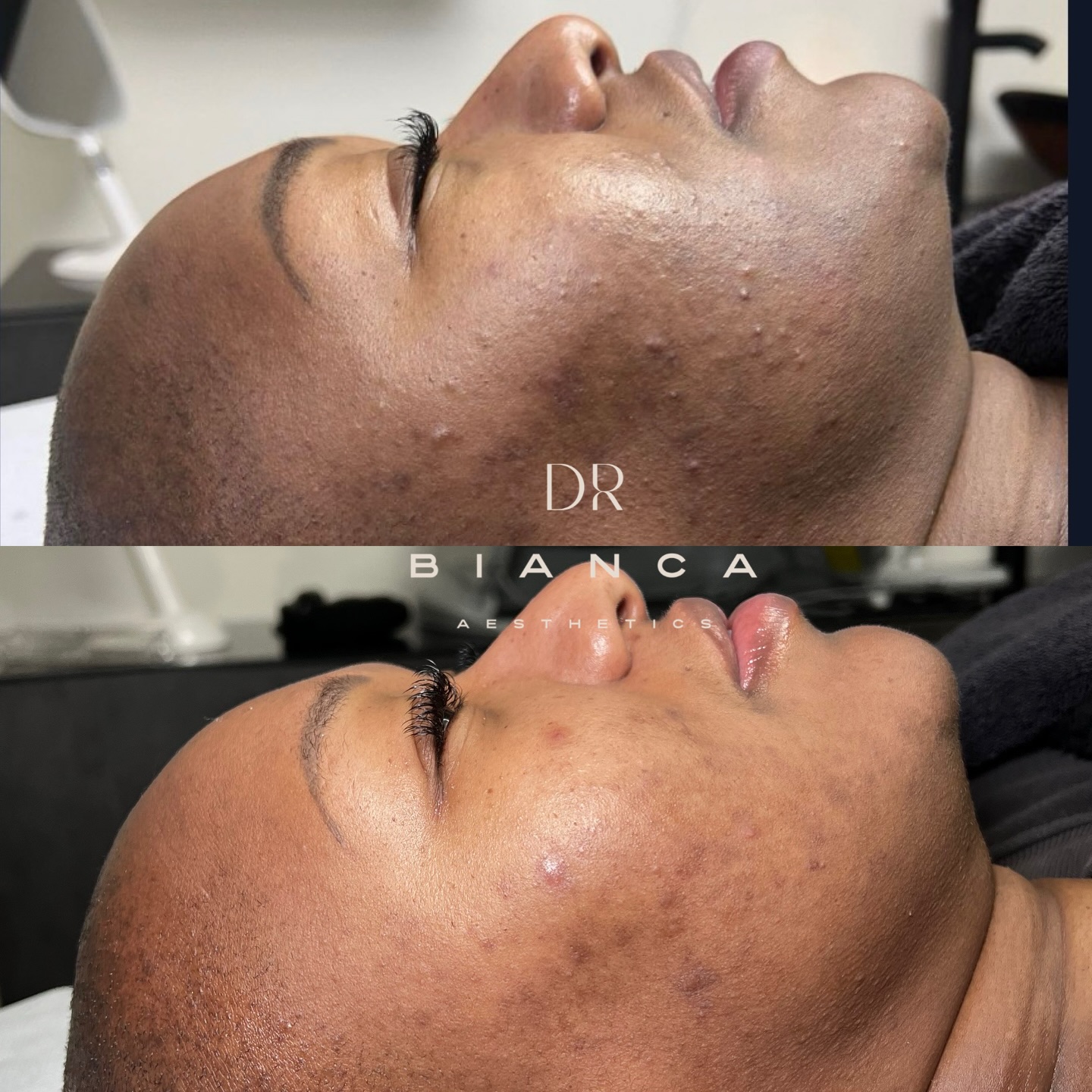 Before ⬆️ / After ⬇️
3 months of consistency, not shortcuts.
Acne and PIH don’t clear overnight — and this is proof that skin is a marathon, not a sprint 🏁
The goal isn’t perfection… it’s progress.
In just 3 months we focused on:
✨ Calming active acne
✨ Supporting the skin barrier
✨ Gradually fading post-inflammatory hyperpigmentation
✨ Strategic pHformula treatments + resurfacing
✨ Microneedling
✨ Committed at-home pHformula skincare
The real win?
Healthier skin that can now respond to treatment instead of constantly reacting.
If you’re dealing with acne or PIH and feeling discouraged, let this be your reminder: consistent care always beats quick fixes. Stay the course. Trust the process. Your skin is listening 🤍
🔗 Book your skin journey here:
👉🏽 www.doctorbianca.co.uk link in bio
#AcneJourney #PIHResults #SkinIsAMarathon #pHformula #Microneedling Resurfacing AcneTreatment Hyperpigmentation ConsistencyIsKey RealSkinRealResults