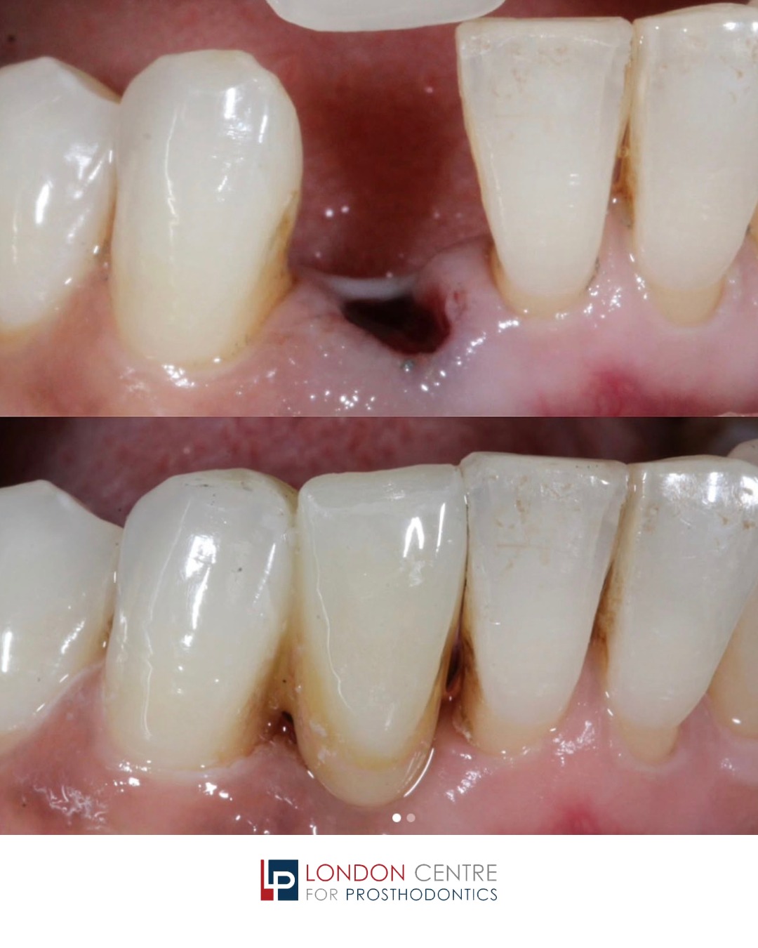 We replaced this patient's missing lower incisor tooth with a bespoke high strength all ceramic bridge made by our master dental technician. This treatment was entirely painless and involved no preparation of the canine support tooth. Adhesive bridges allow us to replace teeth without surgery and using an entirely conservative, painless approach.
If you have a missing tooth, if you are anxious about dental implant surgery and you do not want to wear a denture, an adhesive bridge may be the solution for you!
Great case by Dr Salman 👋🏻
Lab 🔥 by @biteritedigital
Get in touch with our team to book your appointment - we look forward to seeing you soon!
The London Centre For Prosthodontics
29 Weymouth Street
London, W1G 7DB
020 7637 4518
info@londonprosthodontics.com
Monday - Friday: 7:30am - 4:30pm
#SmileMakeover #EmergencyDentistLondon #LondonDentalClinic #SmileTransformation #CosmeticDentistLondon
